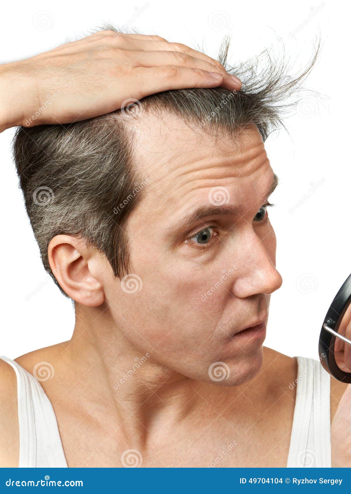 Лысина у мужчин. Лысина у мужчин. Поредевшие волосы у мужчин. Dandruff men. Людей о его волосах.