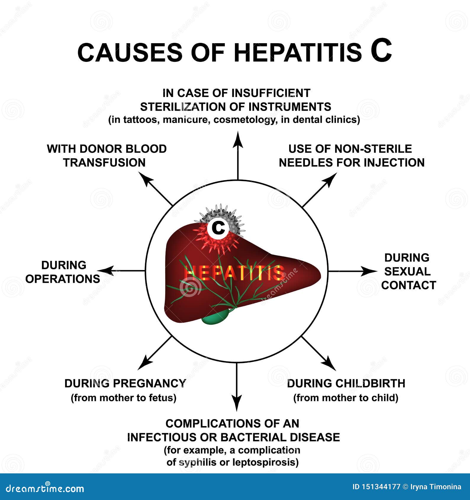 丙型肝炎的原因世界肝炎天infographics R 向量例证 插画包括有infographics 丙型肝炎的原因
