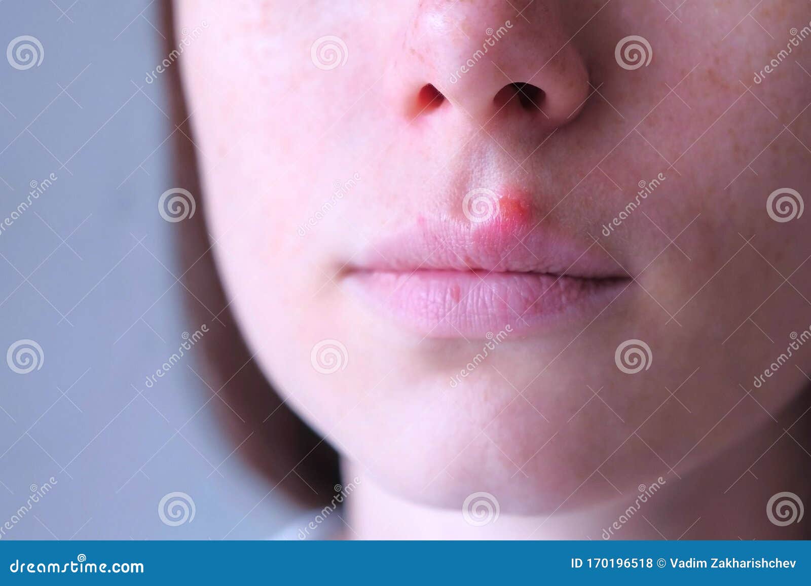 人唇疱疹病毒唇部有疱疹的女性 近视库存照片 图片包括有进程 口头 表面 痛苦 疾病 病症 人唇疱疹病毒唇部有疱疹的女性 近视库存照片 图片包括有进程 口头 表面 痛苦 疾病 病症