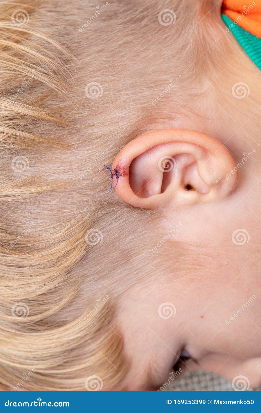 儿童的撕裂伤在幼童的耳朵上耳裂医疗 人身伤害和疼痛概念库存图片 图片包括有适应 子项