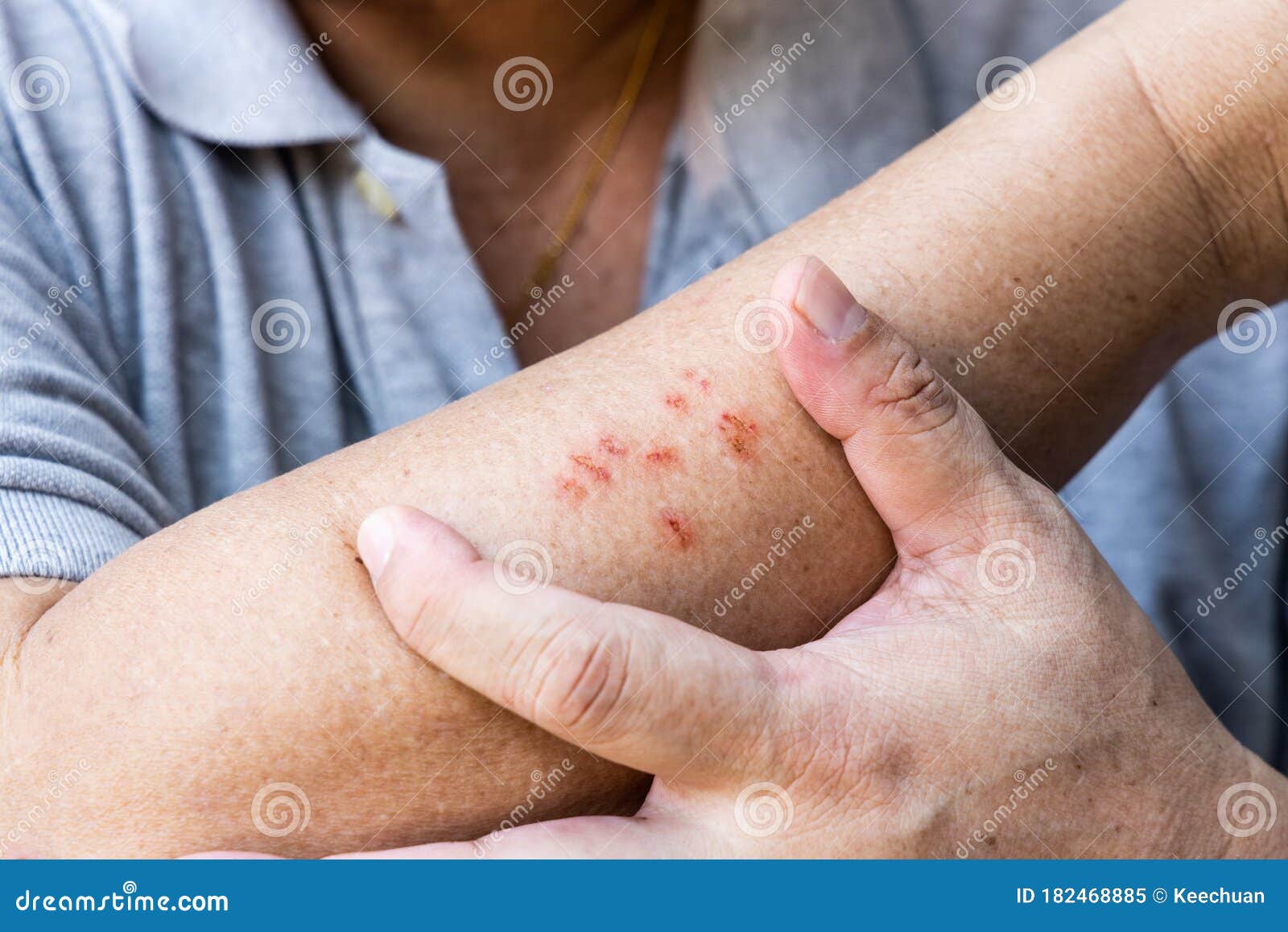 因过敏而刮伤皮肤的人库存图片 图片包括有痛苦 犰狳 聚会所 特写镜头 疼痛 传染 临时