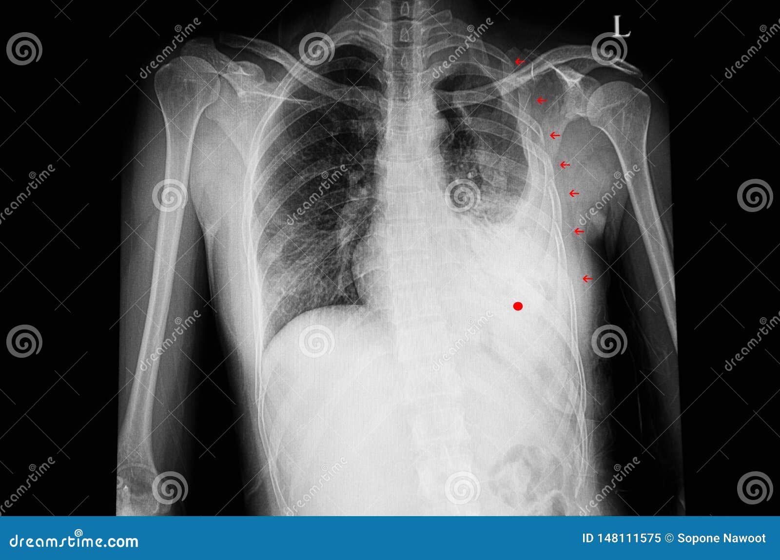 多肋骨破裂和左hemothorax 库存图片 图片包括有爱好健美者 放射学家 胸部 诊断 概要 多肋骨破裂和左hemothorax 库存图片 图片包括有爱好健美者 放射学家 胸部 诊断 概要