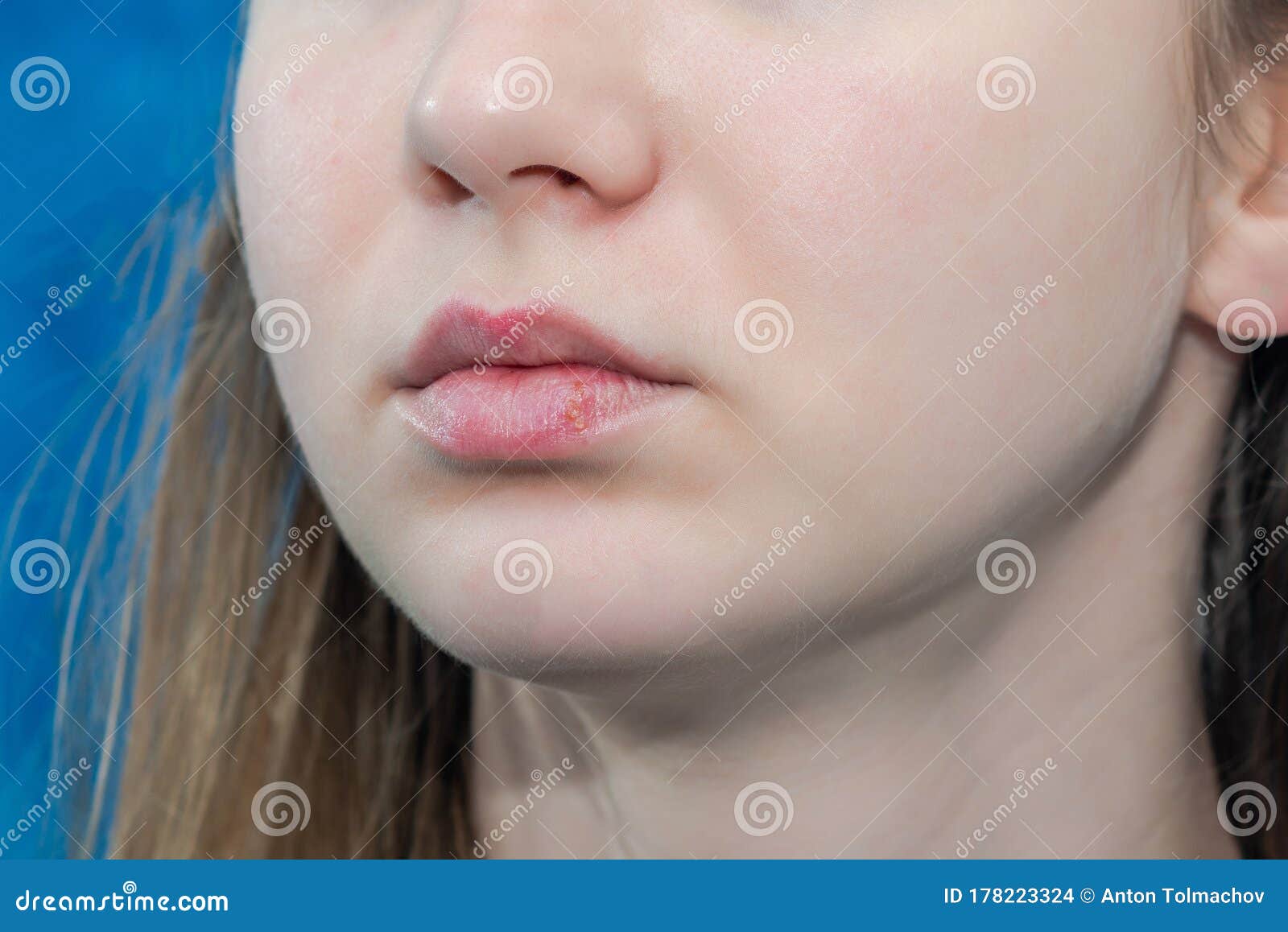 女性双唇疱疹的特写嘴唇病毒感染疱疹库存照片 图片包括有表面 情况 女主持人 投诉 传染 女性双唇疱疹的特写嘴唇病毒感染疱疹库存照片 图片包括有表面 情况 女主持人 投诉 传染