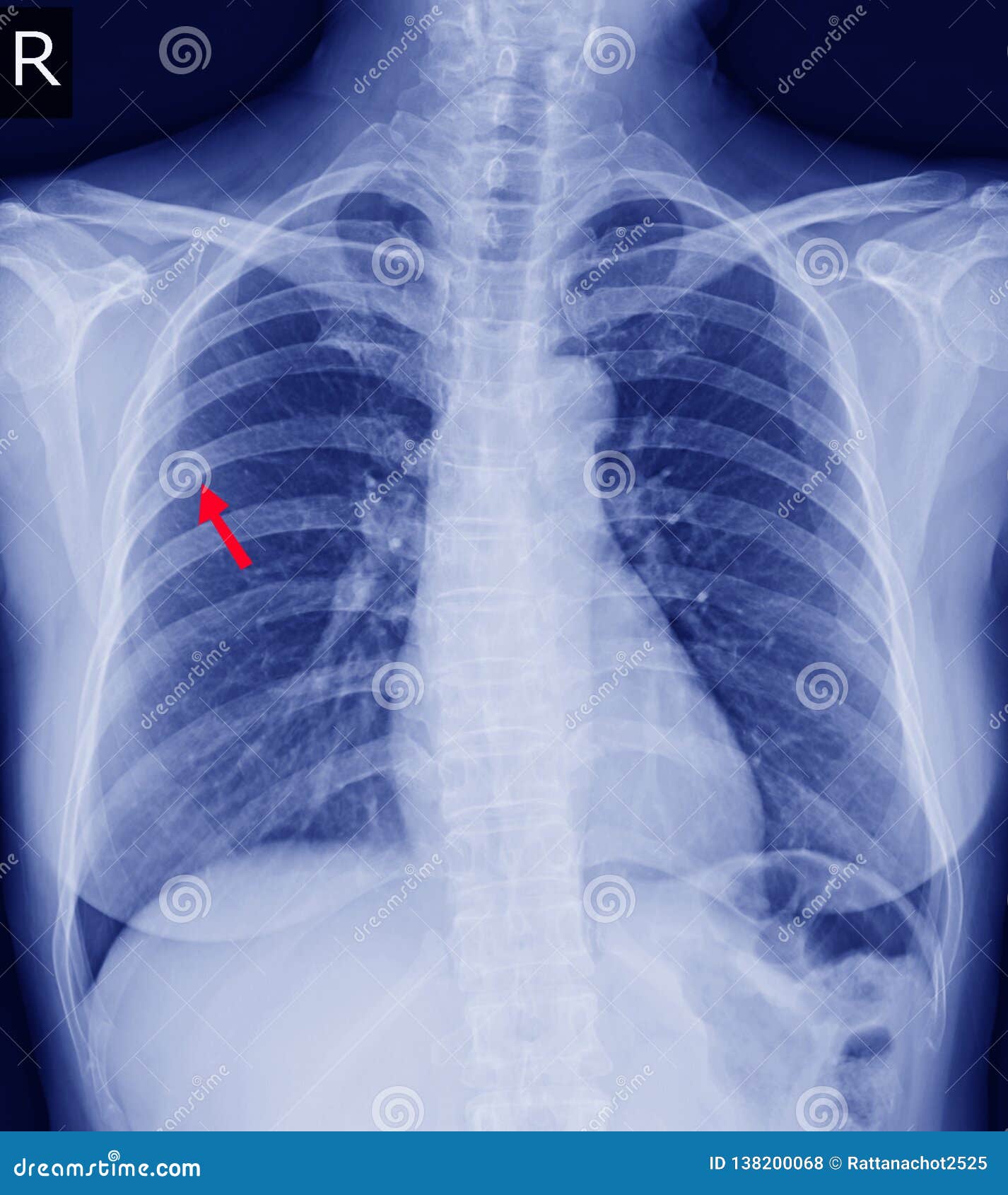 左边第9块肋骨的胸部x光破裂权利后部第6块肋骨和可能的破裂侧向方面库存照片 图片包括有