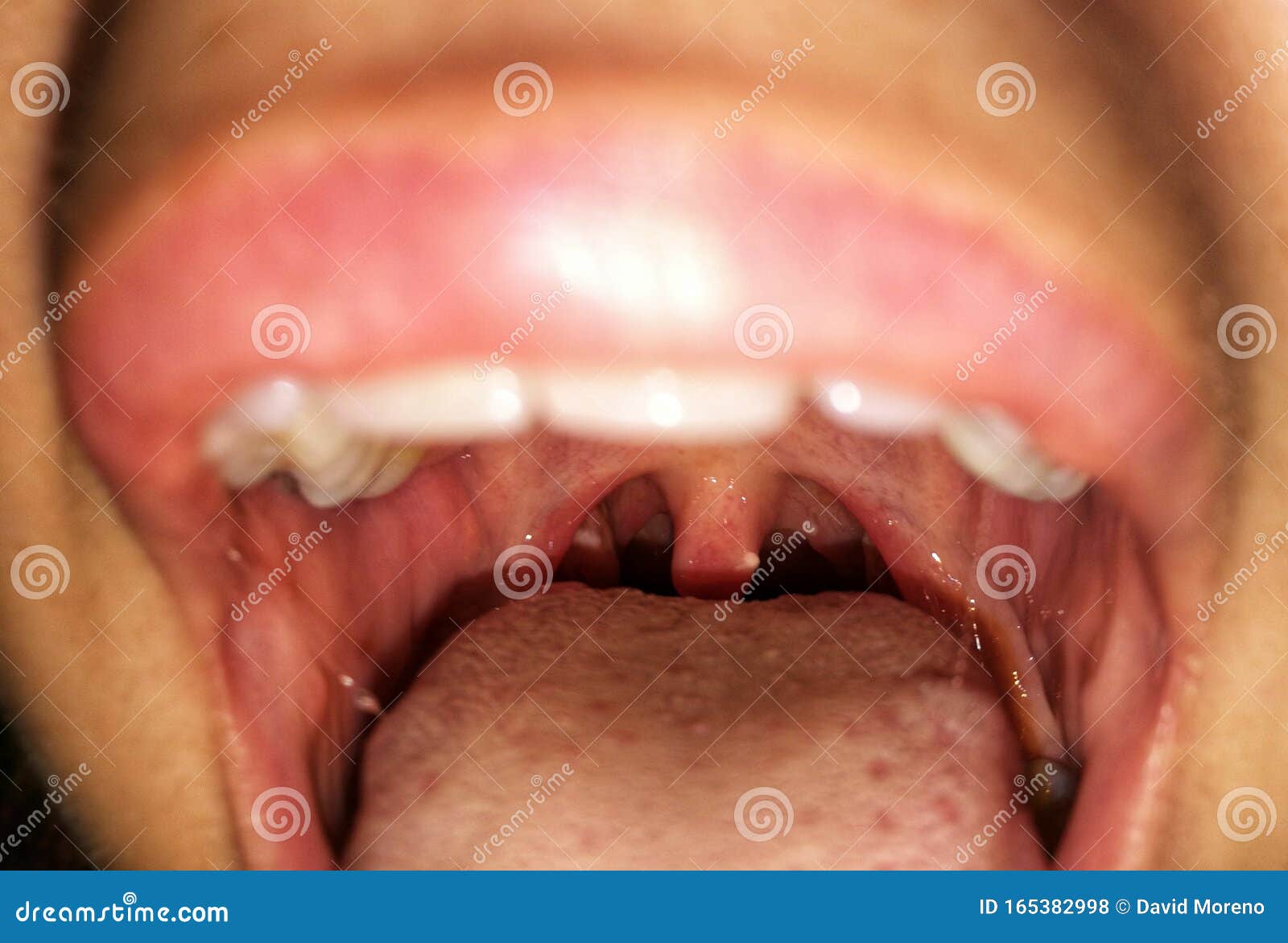 张嘴的女人双侧扁桃腺带脓斑的放大近视库存照片 图片包括有射入 上颚 重婚 特写镜头 扁桃腺炎
