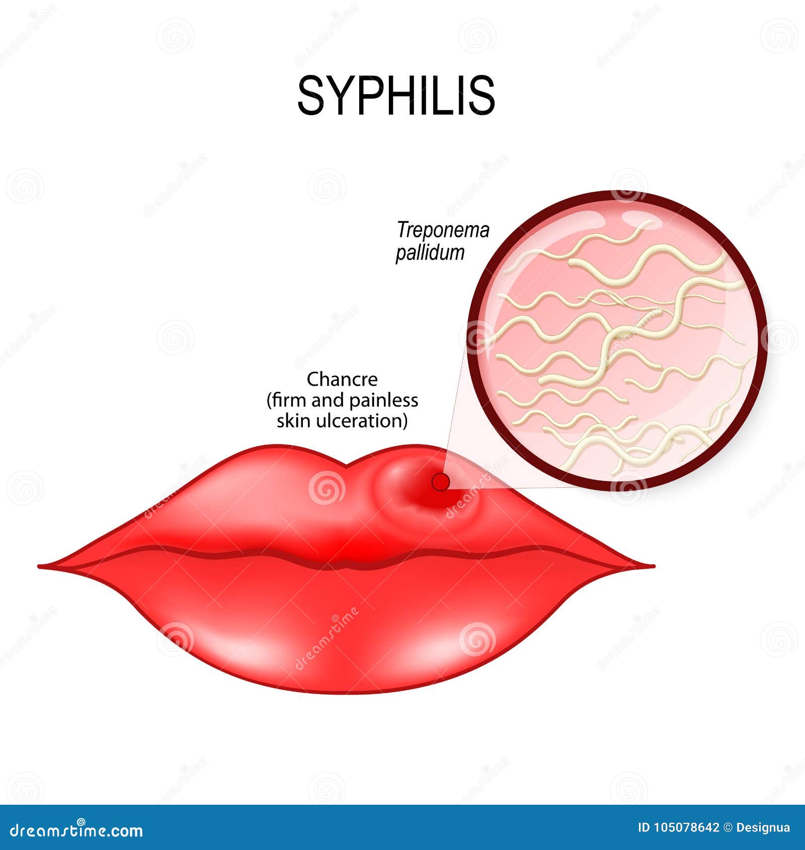 梅毒有下疳的人的嘴唇苍白球的密螺旋体 向量例证 插画包括有
