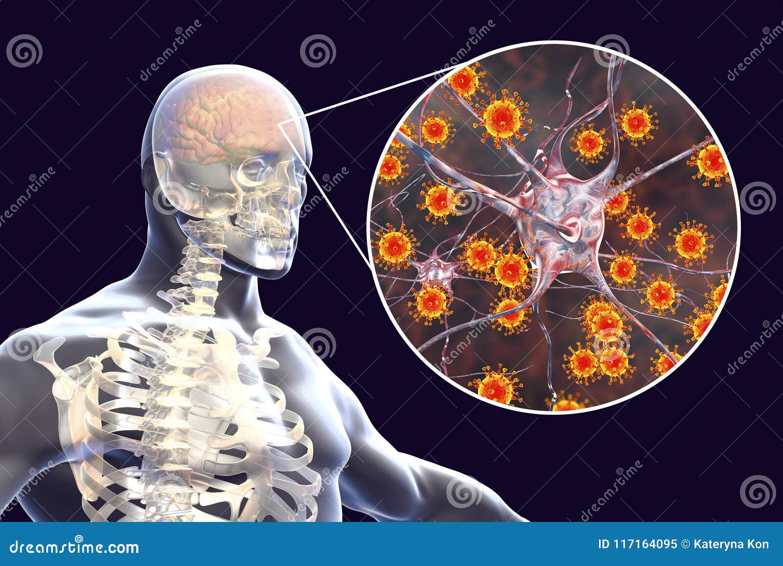 病毒脑膜炎和脑炎 医疗概念库存例证 插画包括有腮腺炎 针灸师 日语 概念性 脑膜炎 紧张 病毒脑膜炎和脑炎 医疗概念库存例证 插画包括有腮腺炎 针灸师 日语 概念性 脑膜炎 紧张