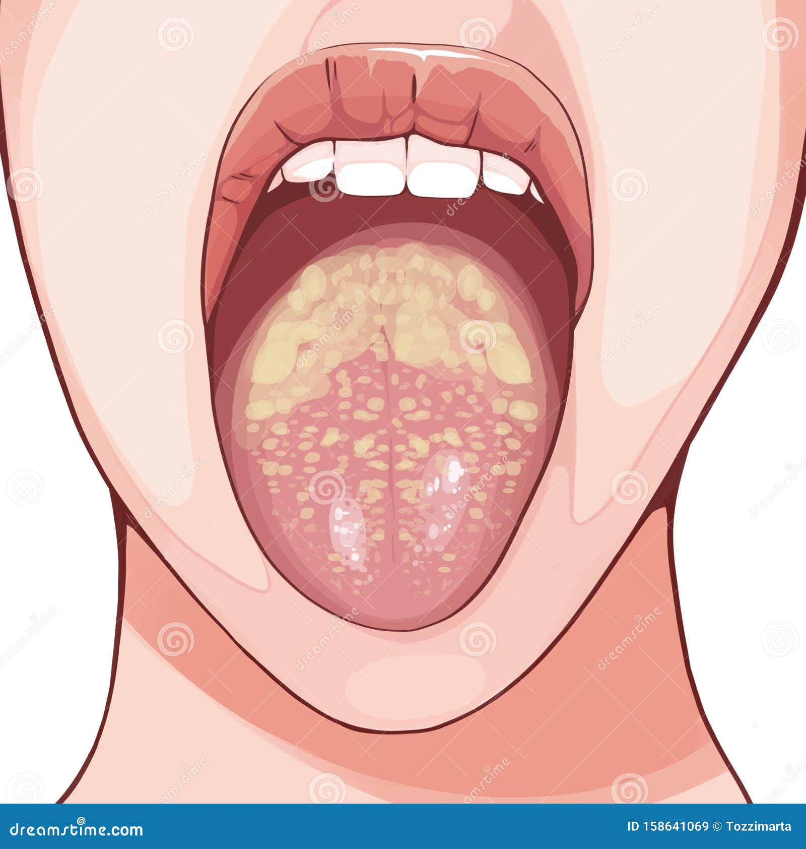 白色念珠菌感染库存例证 插画包括有例证 传染 关心 激动 背部 裂痕 导致 特写镜头 白色念珠菌感染库存例证 插画包括有例证 传染 关心 激动 背部 裂痕 导致 特写镜头