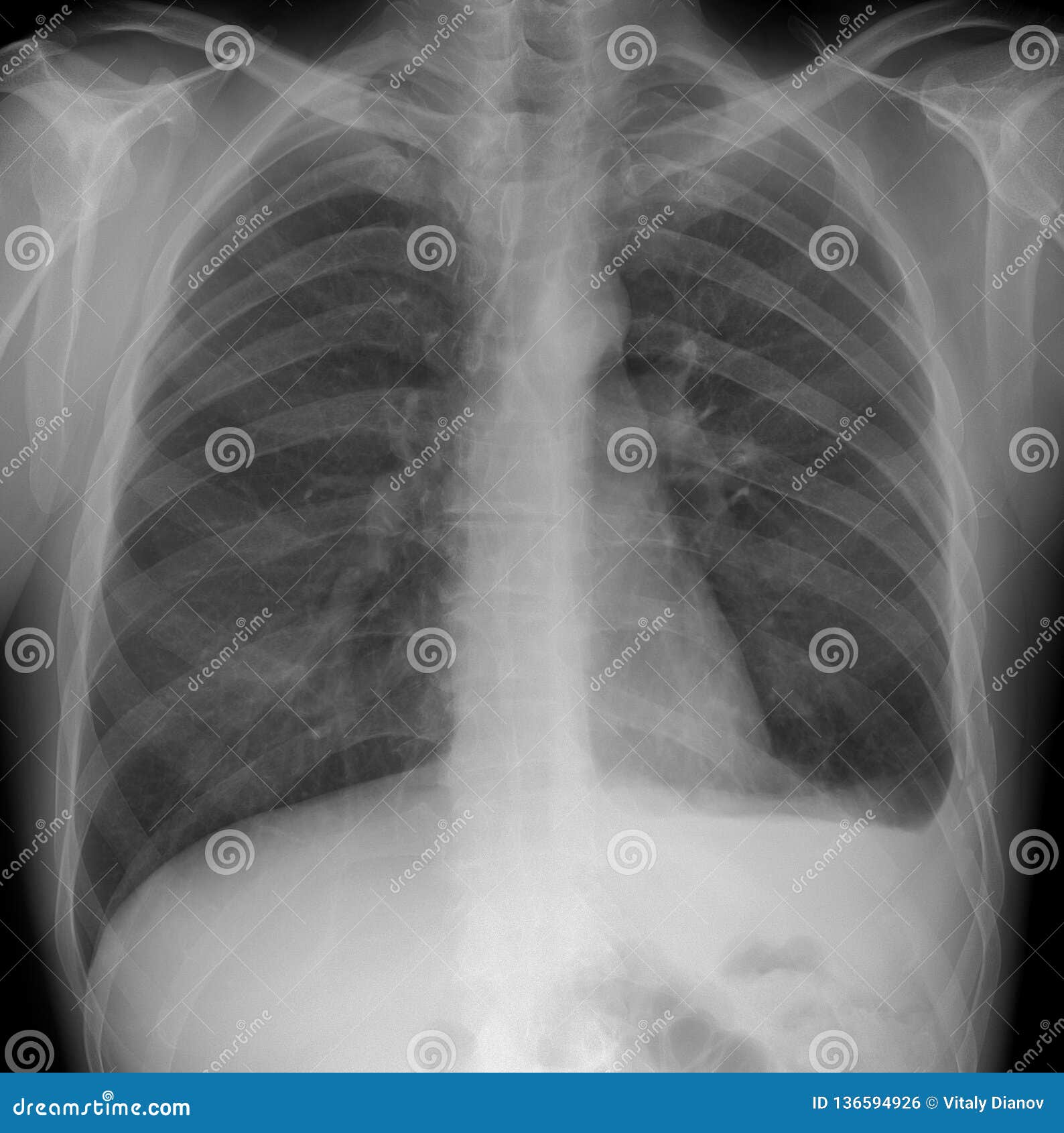 肺的x 射线 Hemothorax 左边的肋骨破裂库存照片 图片包括有 肺的x 射线 Hemothorax 左边的肋骨破裂库存照片 图片包括有