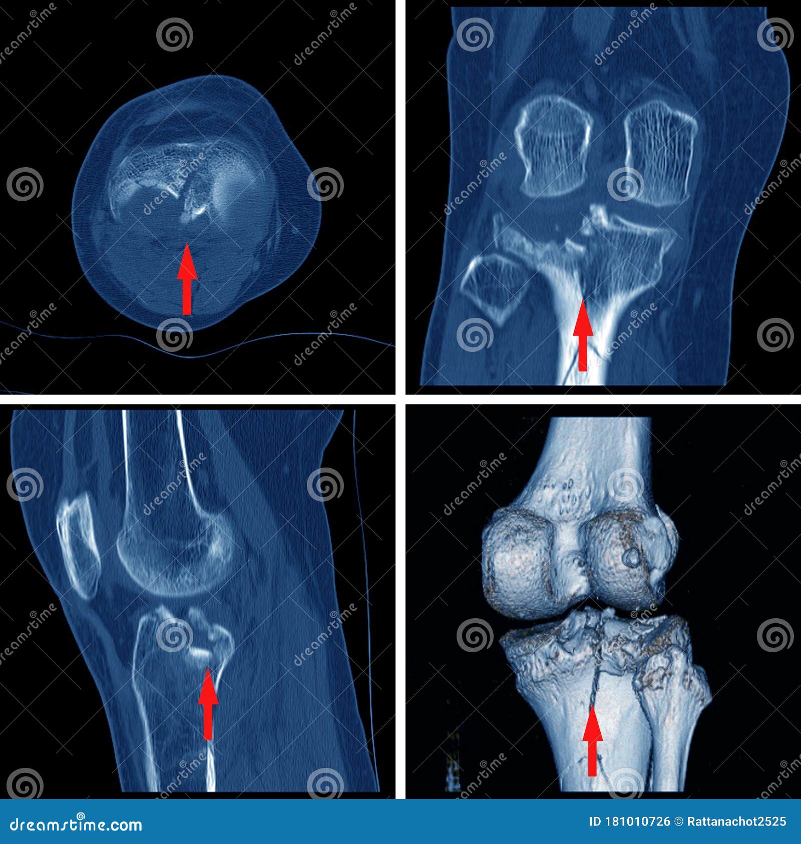 胫骨髁间隆起的ct膝骨折库存照片 图片包括有医生 患者 适应 考试 腓骨 医院 矫形