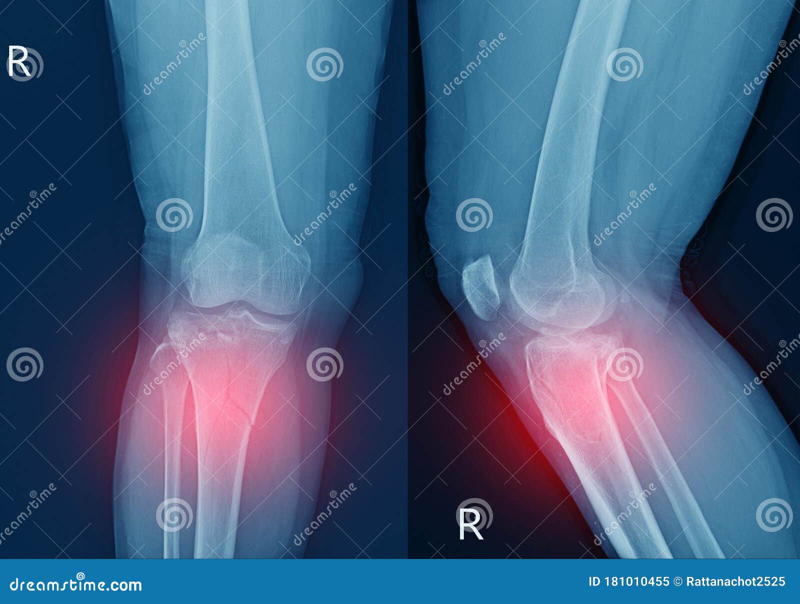 胫骨x线膝骨近端干部骨折胫骨平台侧部凹陷性骨折软组织严重肿胀库存图片 图片包括有联接 韧带
