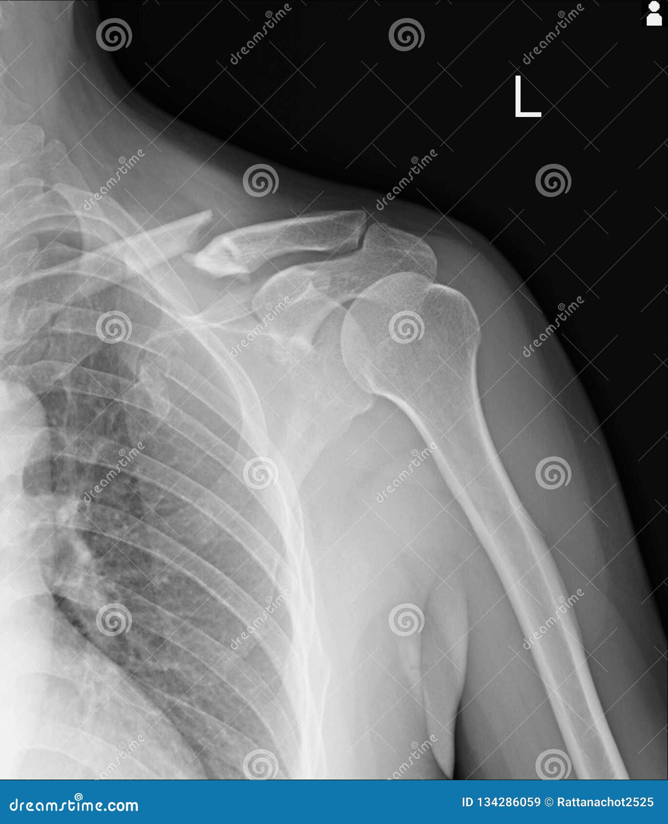 胸部x光破碎左锁骨 先前第2块肋骨 后部肋骨4 5和左边第6块肋骨的侧向方面库存图片 图片包括有