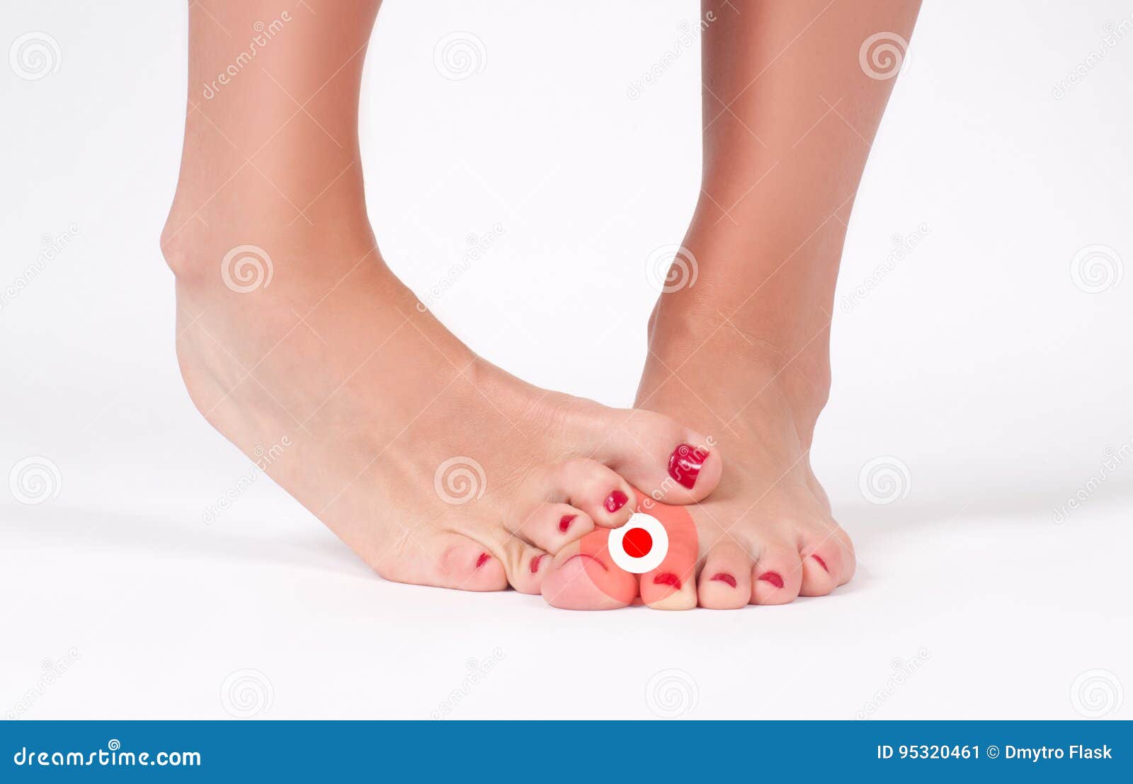 脚真菌在白色背景的女性脚库存图片 图片包括有 脚真菌在白色背景的女性脚库存图片 图片包括有