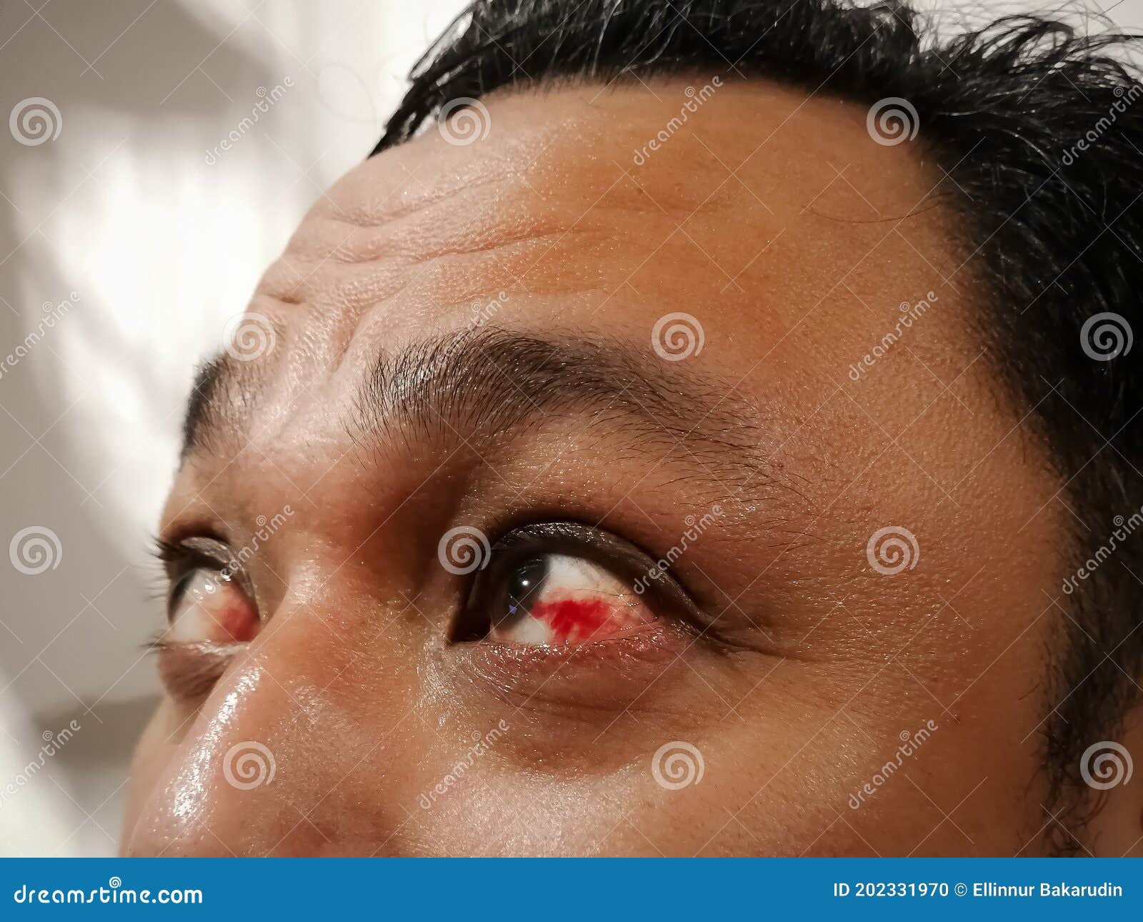血眼 眼眶爆裂的亚洲男子 红色的眼珠 眼部出血损伤库存照片 图片包括有医学 出血 血眼 眼眶爆裂的亚洲男子 红色的眼珠 眼部出血损伤库存照片 图片包括有医学 出血