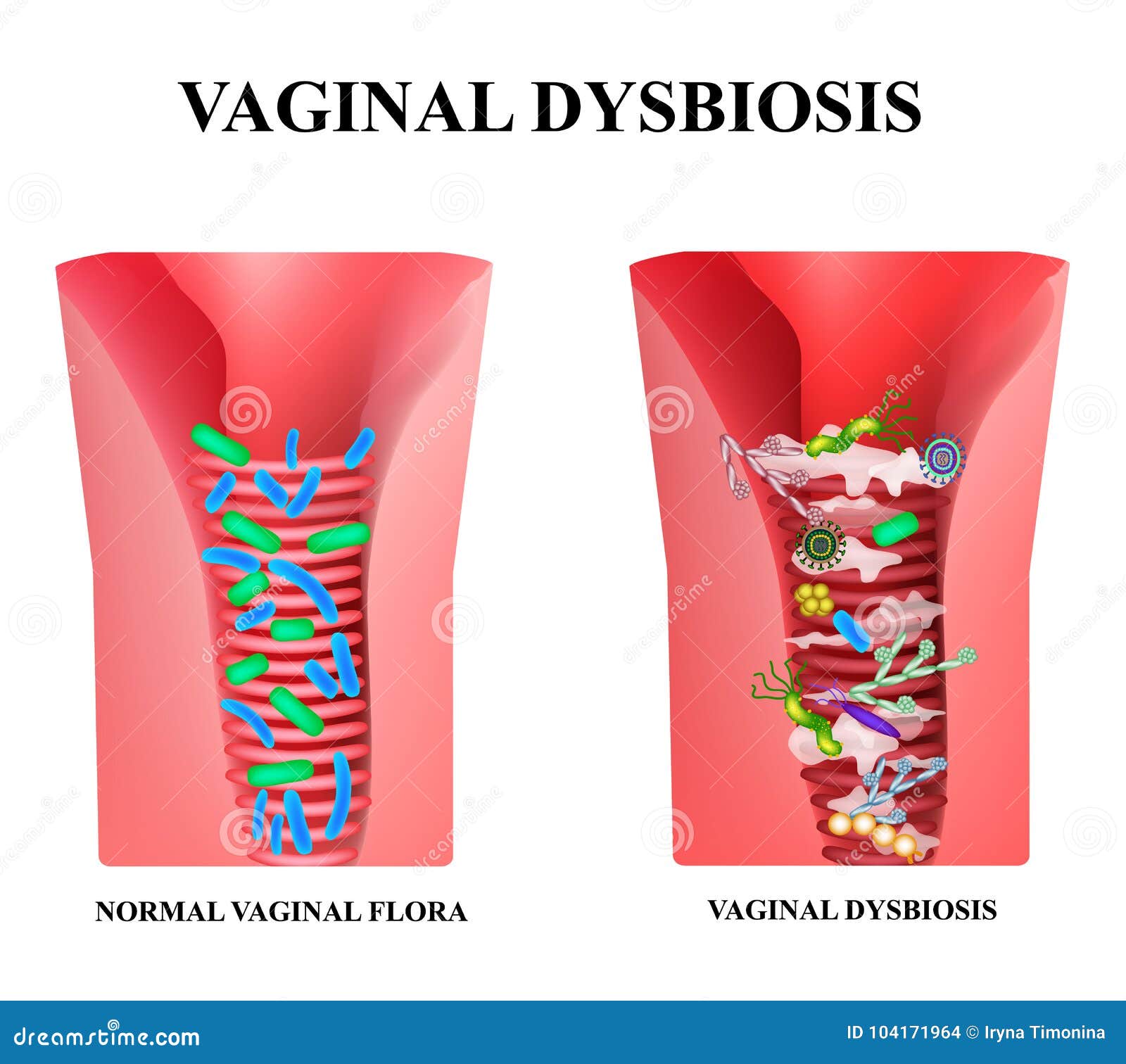 阴道 阴道dysbiosis 阴道的Dysbacteriosis 鞘炎念珠菌病乳酸杆菌属， Bifidobacteria 细菌致病性植物群向量例证-  插画包括有乳汁, 掘泥机: 104171964