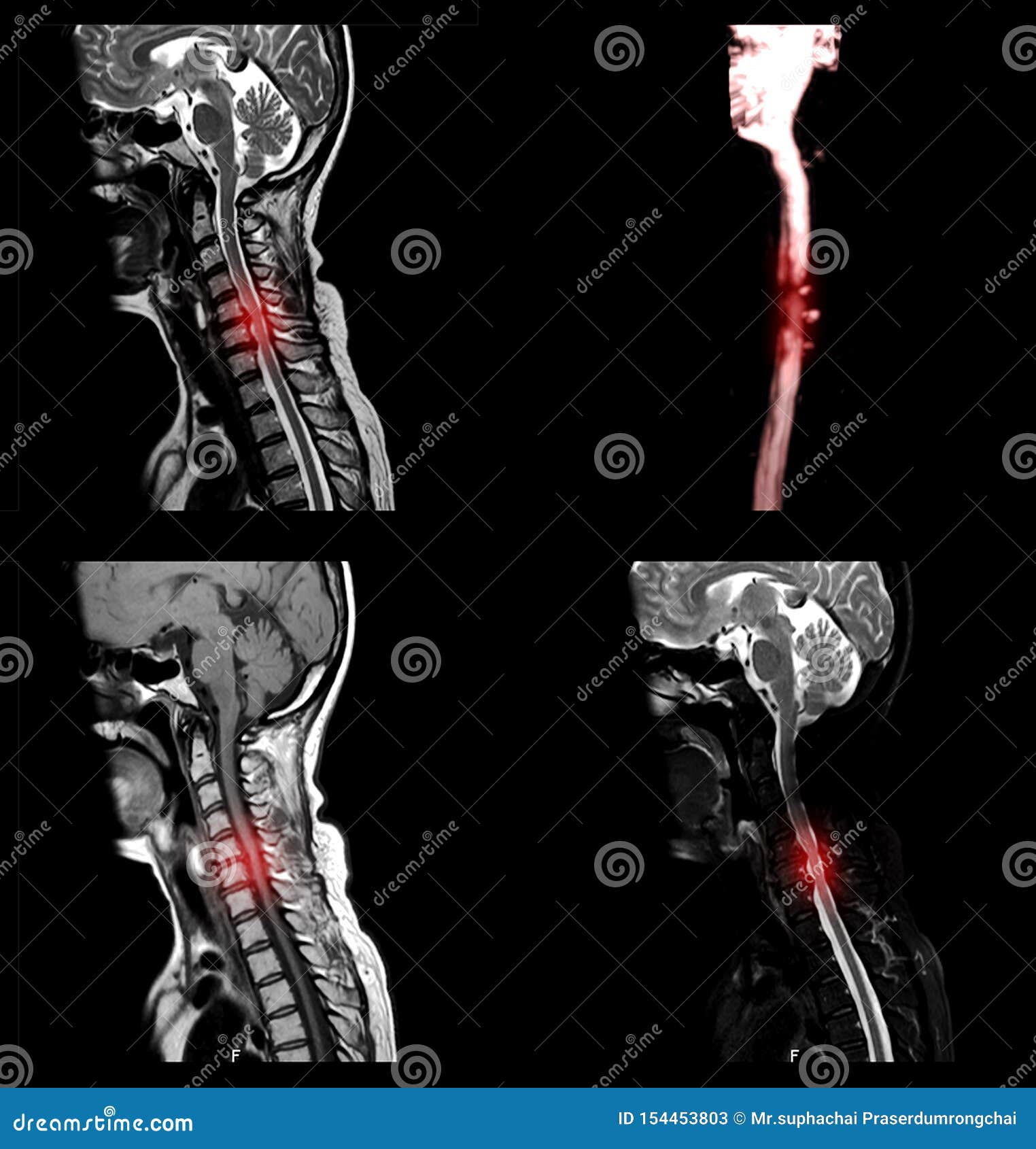 颈椎的mri C脊或磁共振成像库存图片 图片包括有 颈椎的mri C脊或磁共振成像库存图片 图片包括有