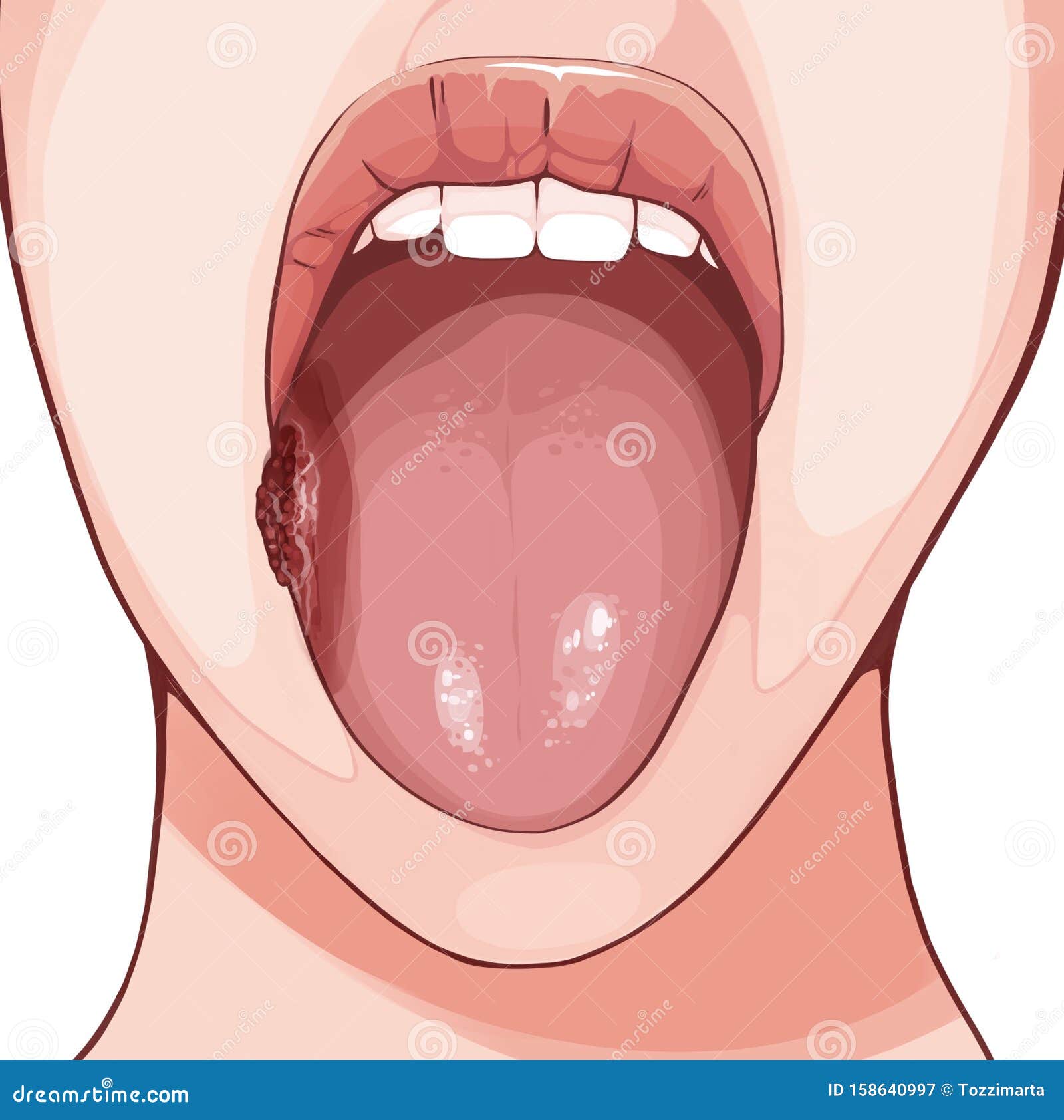 鳞状细胞癌是最常见的舌癌库存例证 插画包括有女性 塑料 药剂 设置 嘴唇 容器 医疗