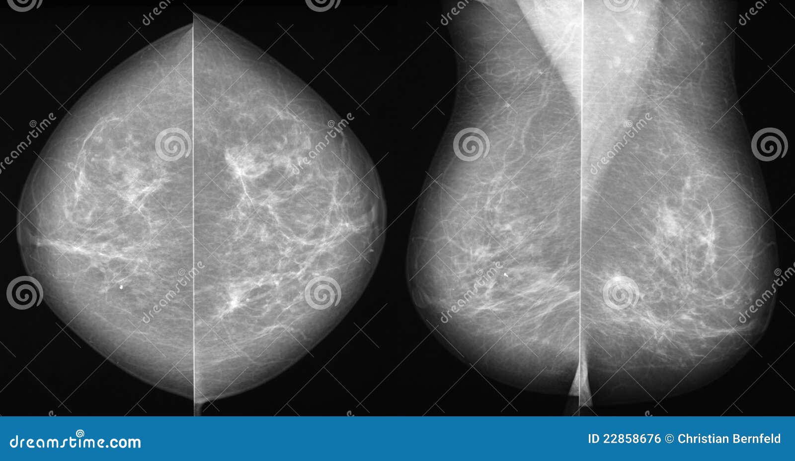 乳腺多形性小叶原位癌