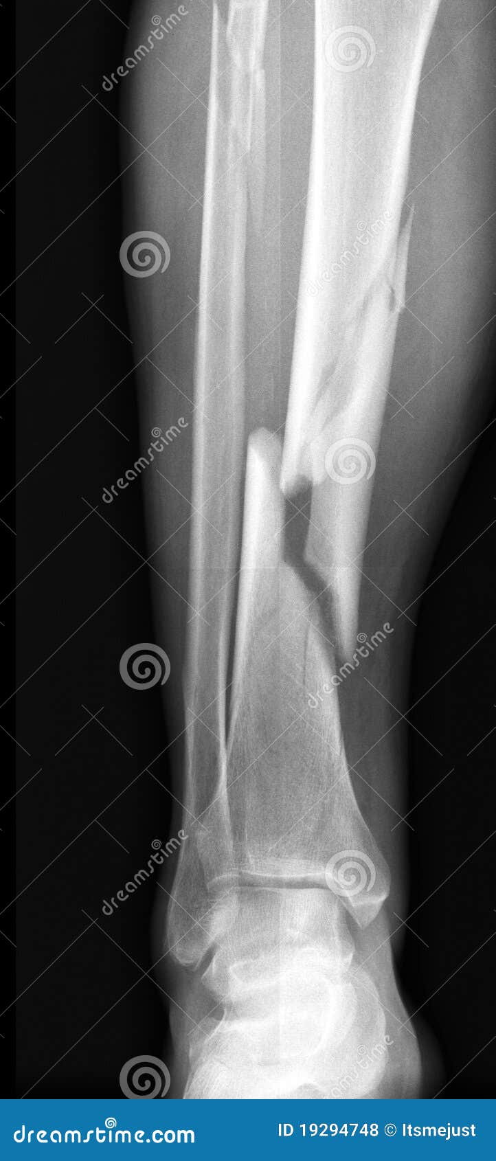 Трещина кости на ноге. Бамперный перелом голени рентген.