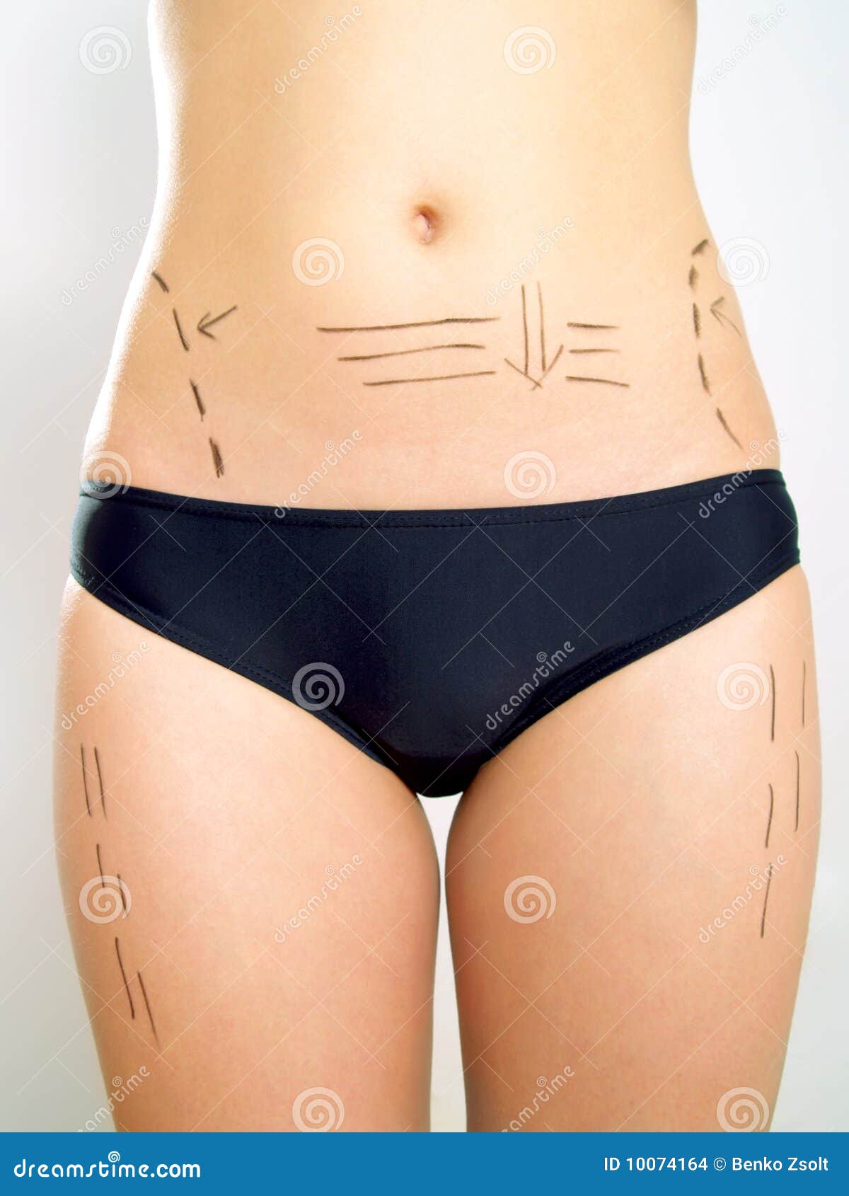 Abdomen, Waist, Thigh Marked For Plastic Surgery Stock Photo Image of female, abdomen 10074164