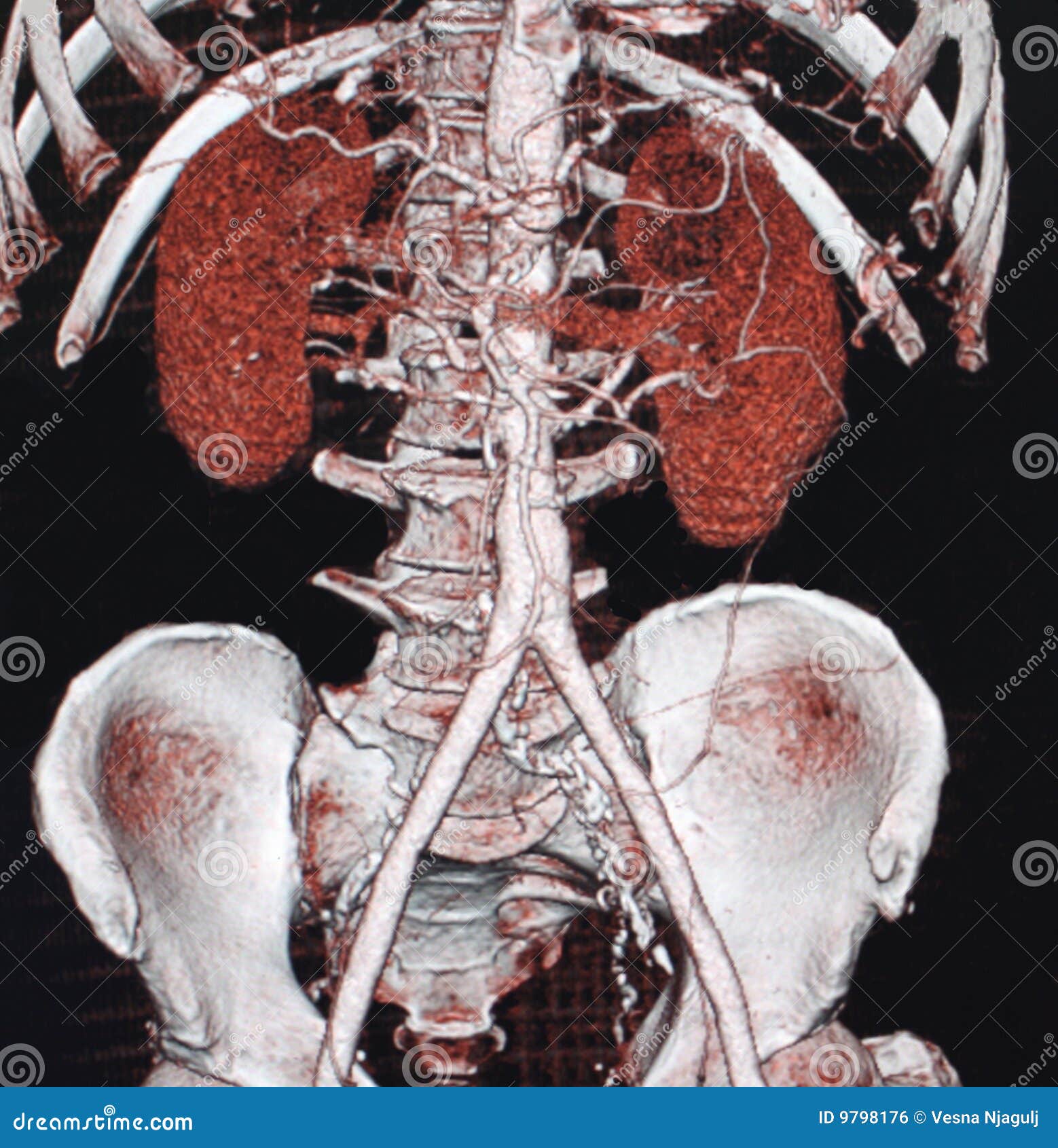 abdominal aortic aneurysm, ct