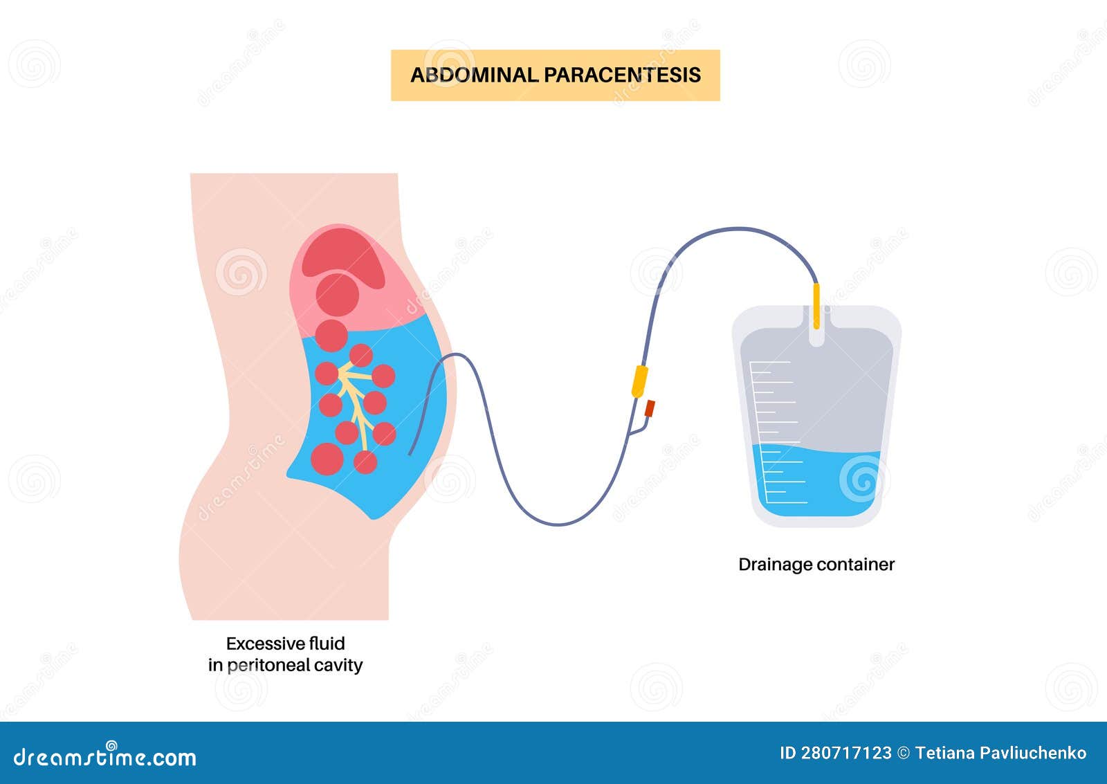 Abdominal Paracentesis Poster Stock Vector - Illustration of peritoneum ...