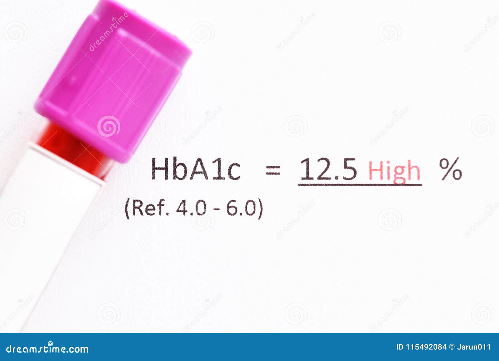 Abnormal High Level HbA1c Test Result Stock Photo Image of mellitus