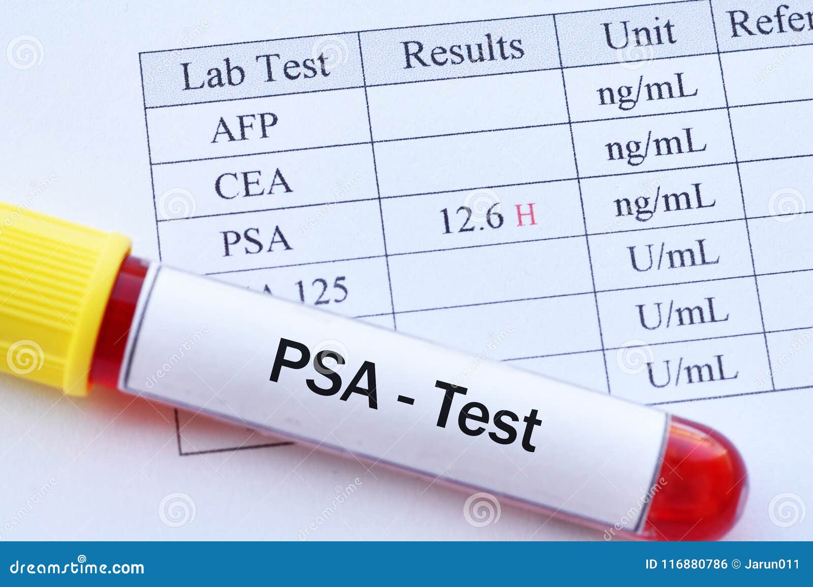 Abnormal High PSA Test Result Stock Photo - Image of antigen, form ...