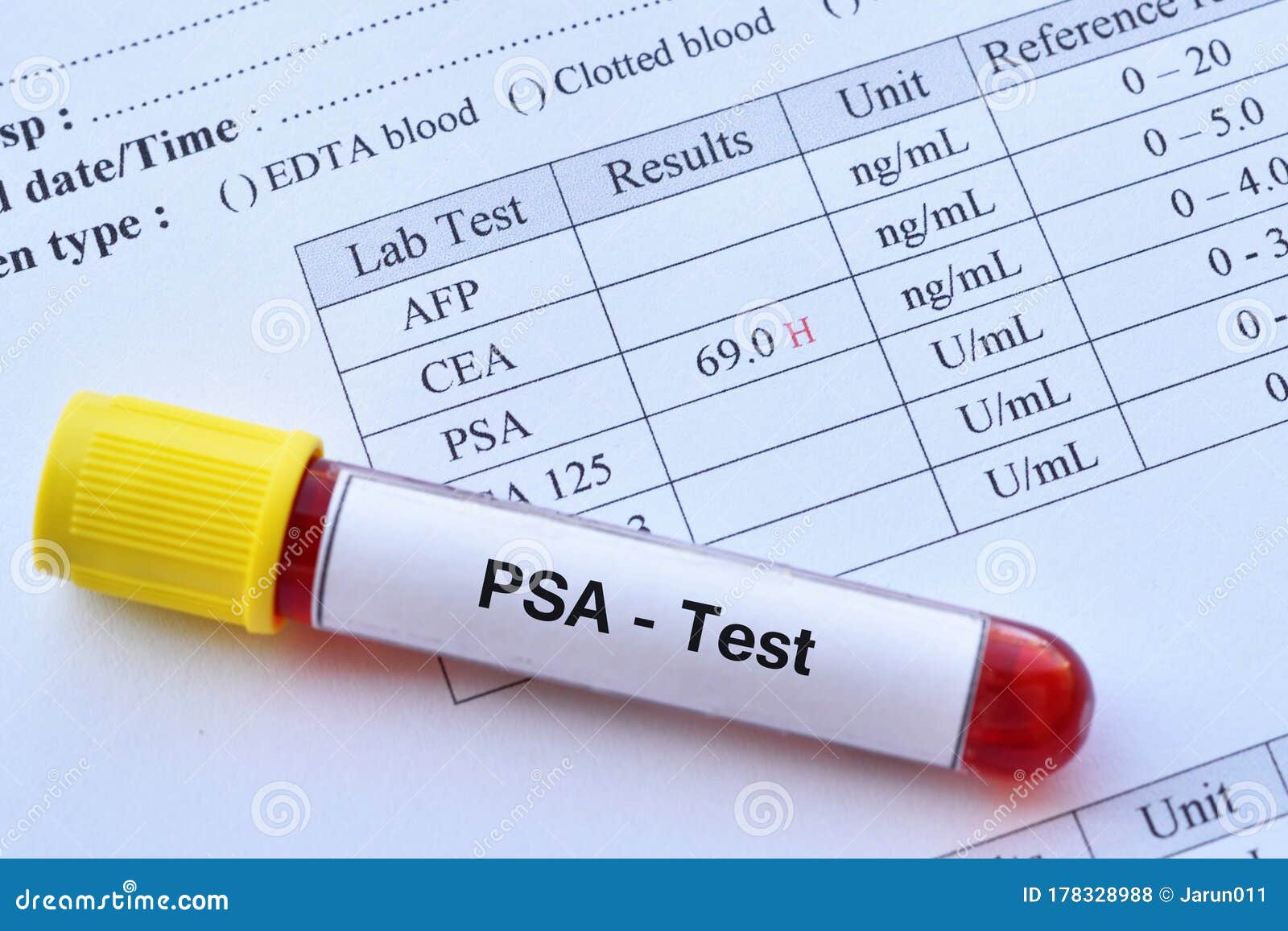Abnormal High PSA Test Result Stock Photo - Image of hematology ...