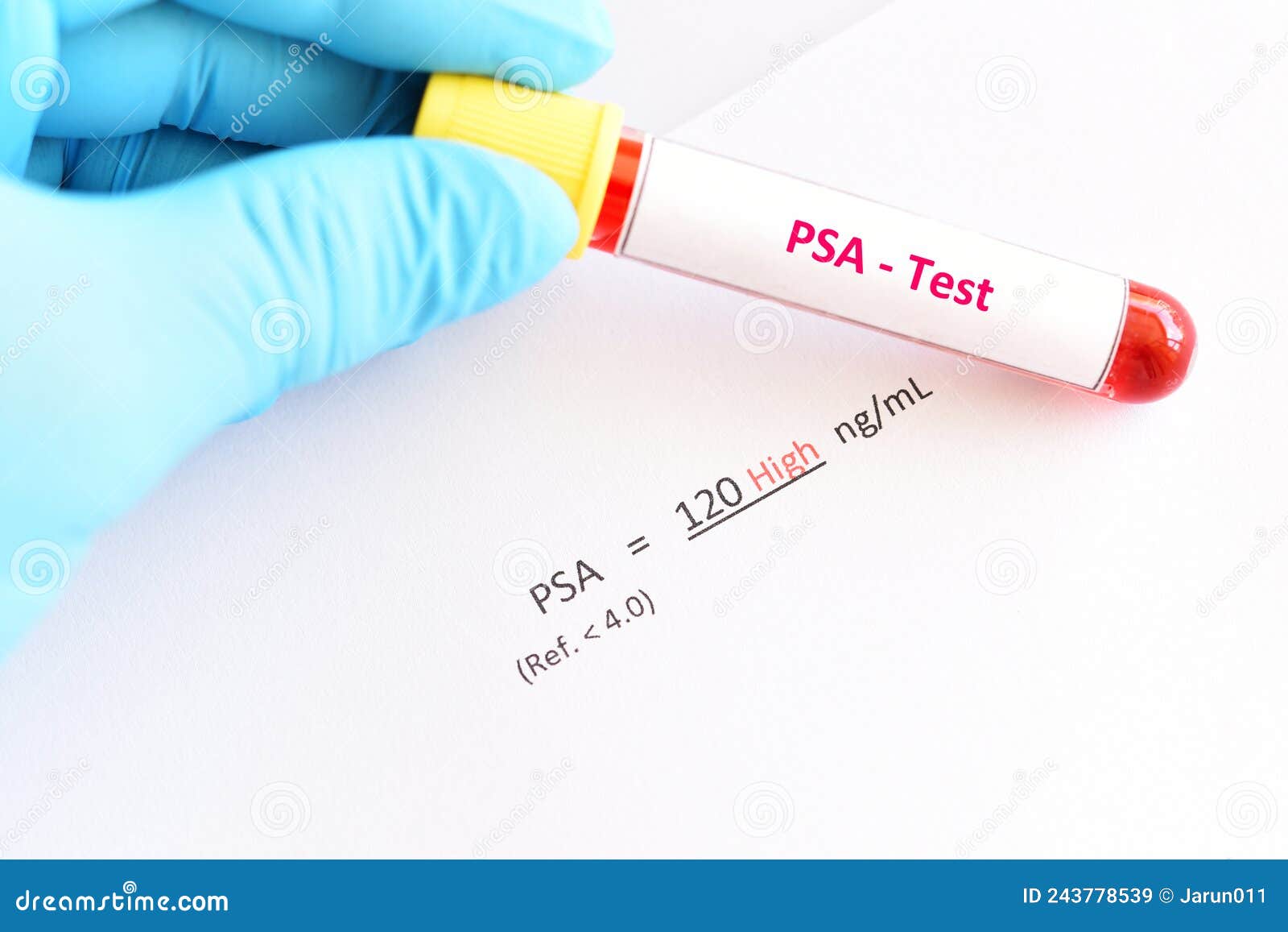 Abnormal High PSA Test Result Stock Image - Image of abnormal, disease ...