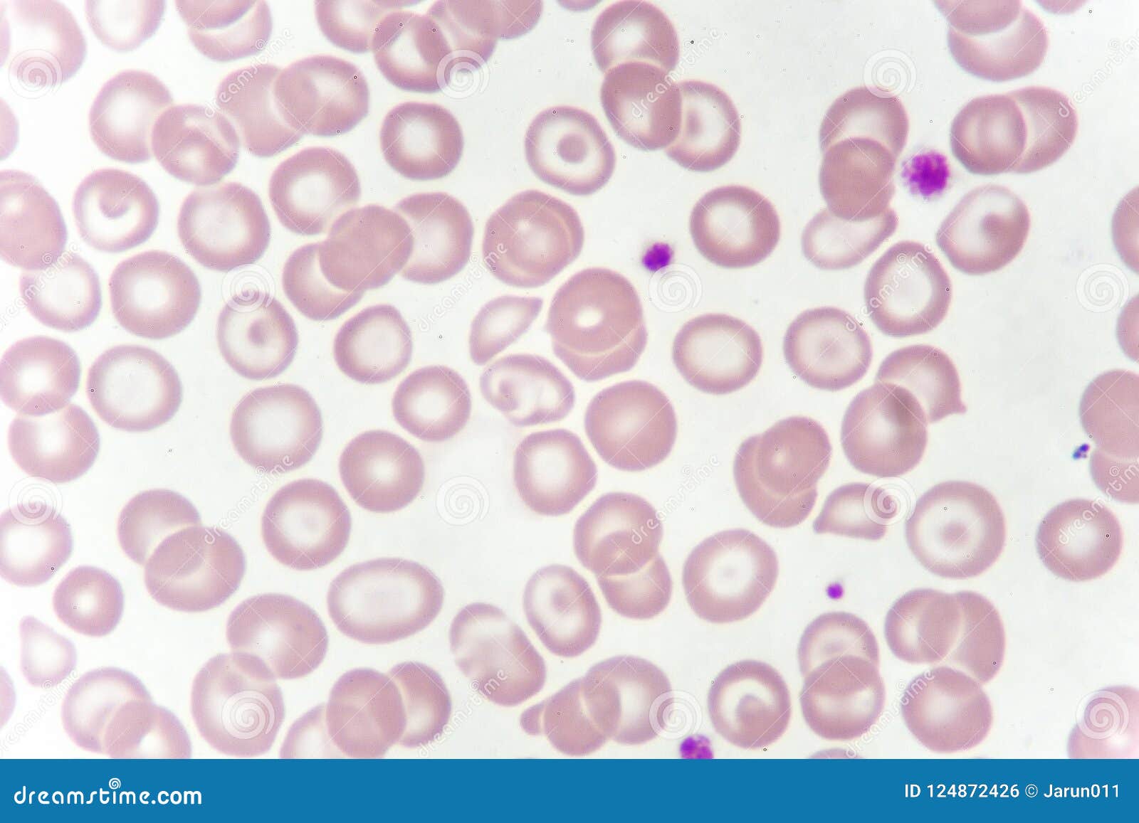 abnormal red blood cells from anemia patient