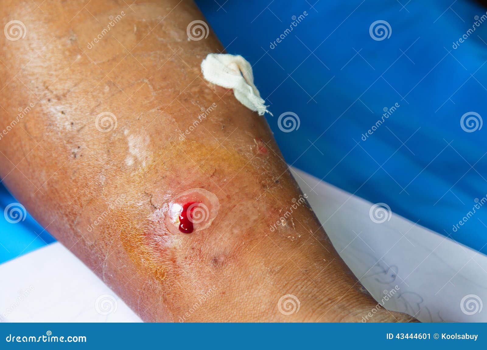 Abscess leg dressing. stock image. Image of care, closeup 43444601