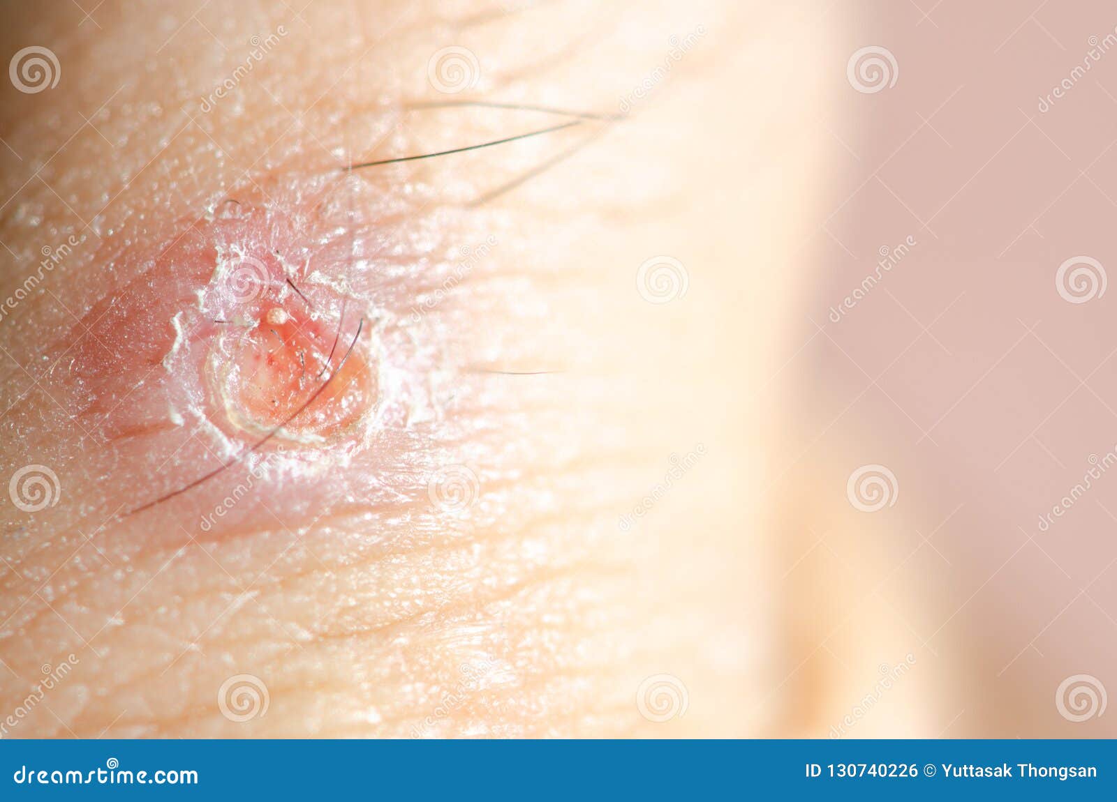 Abscess Wound. RoyaltyFree Stock Image 74161822