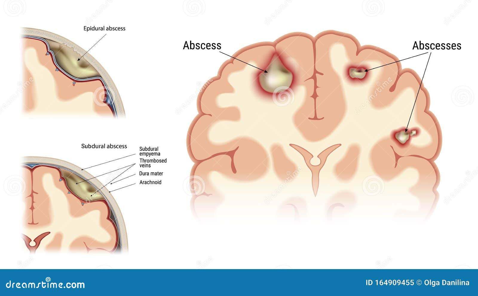 Abscess set vector stock vector. Illustration of medicine 164909455