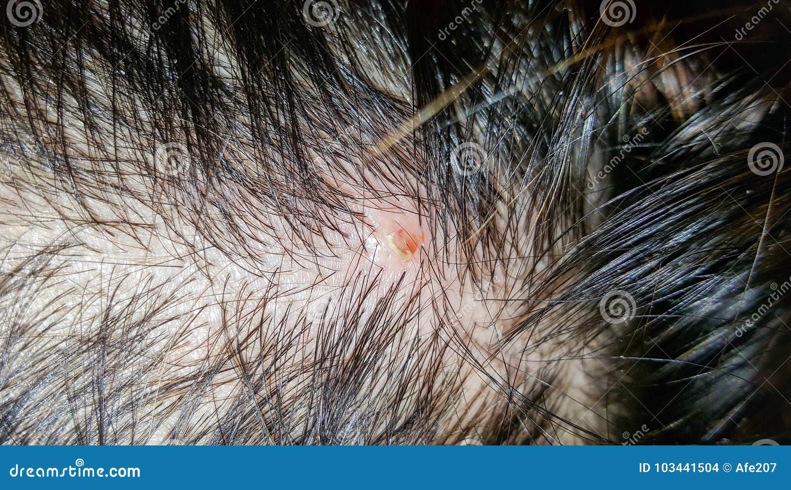 Abscess on skin head stock photo. Image of blood, illness 103441504