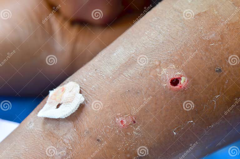 Abscess wound. stock photo. Image of reconstruction, blood 43444590