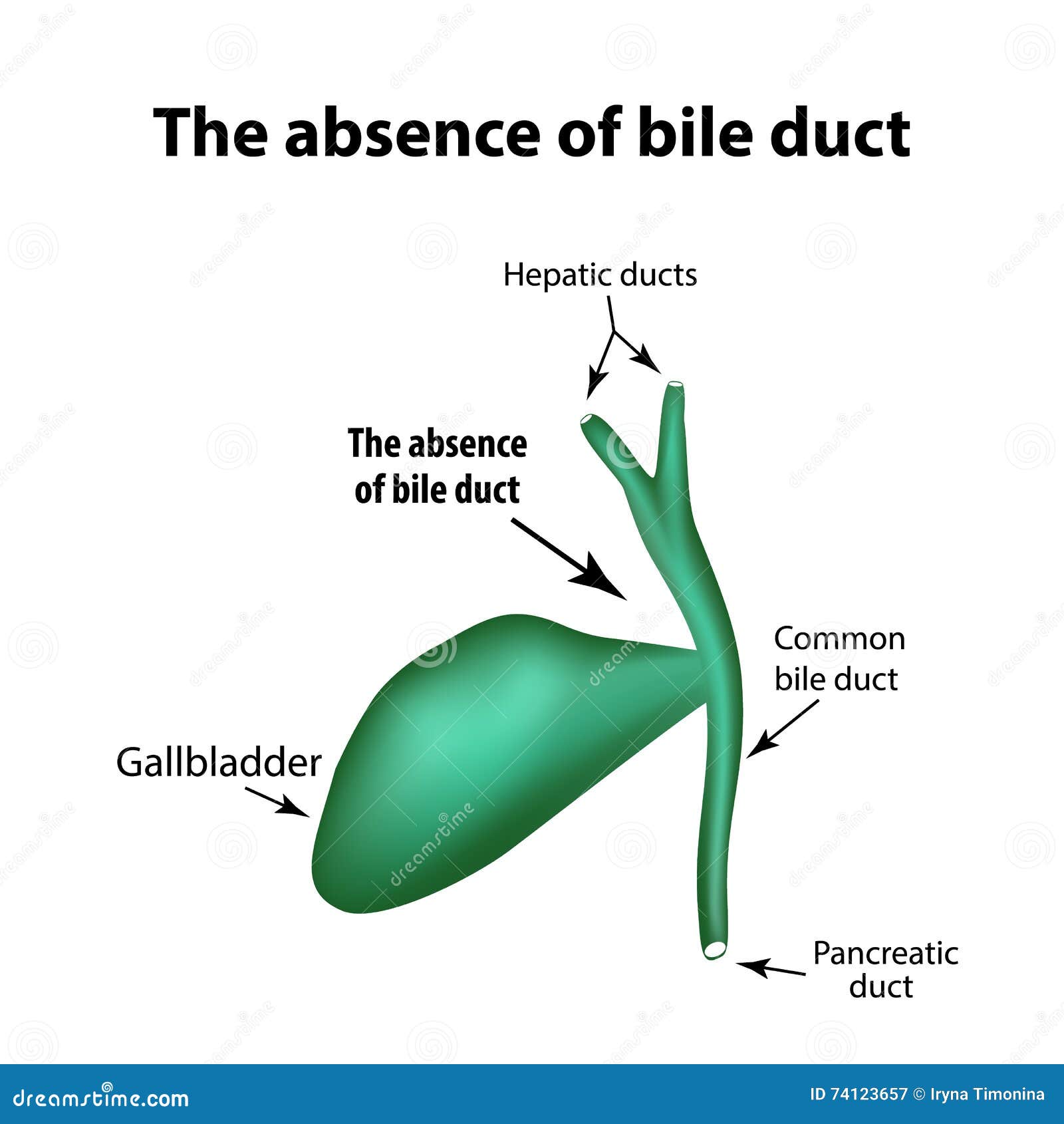 the absence of bile duct. pathology of the gallbladder. cholecystitis.