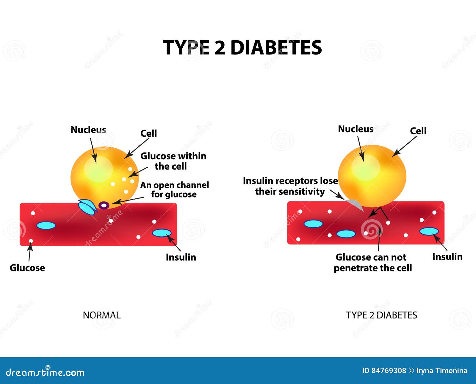 The Absorption Of Glucose By The Cell Type 2 Diabetes Stock the-absorption-of-glucose-by-the-cell-type-2-diabetes-stock