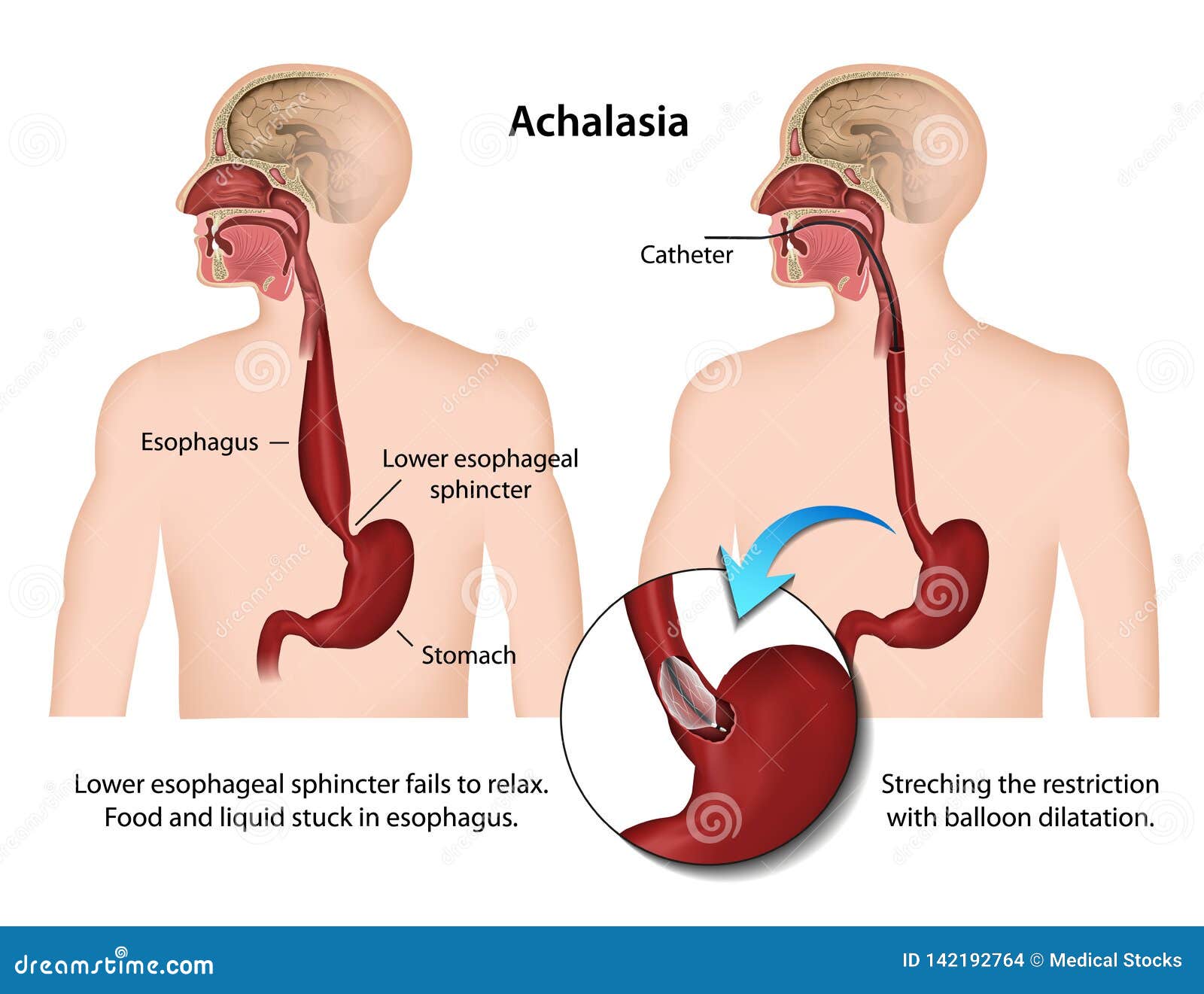 achalasia of the esophagus 3d medical  