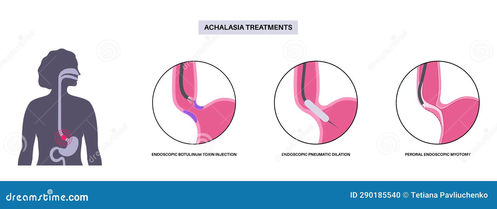achalasia treatments procedures