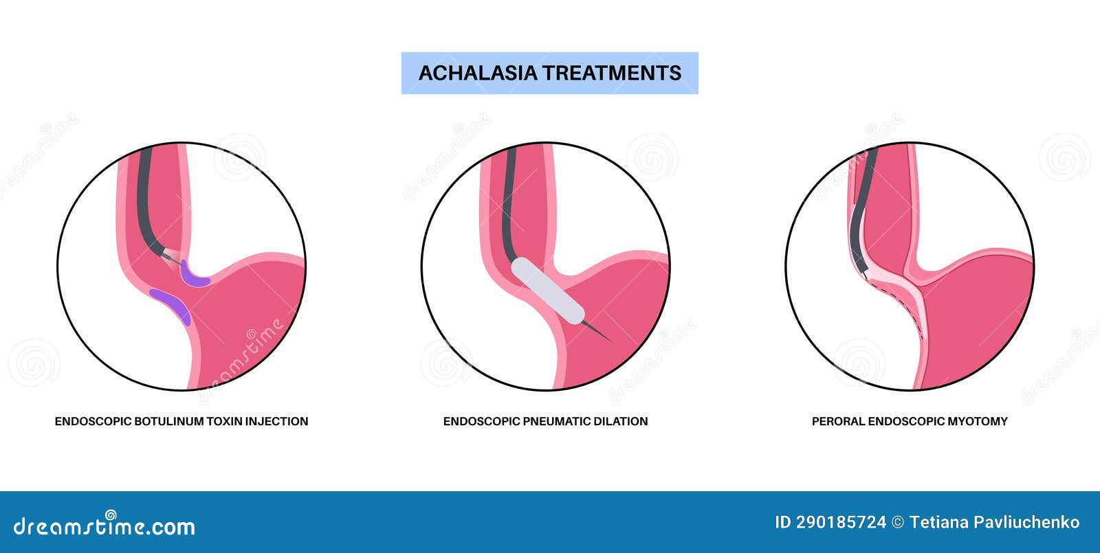 achalasia treatments procedures