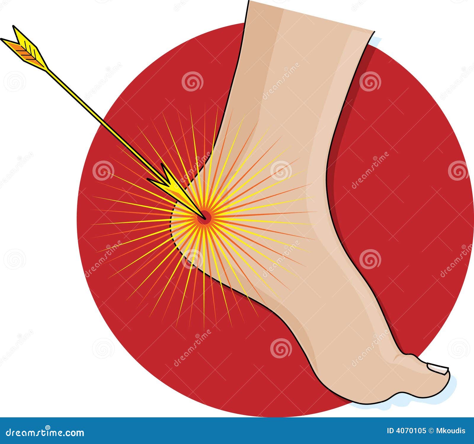 Achilles heel art