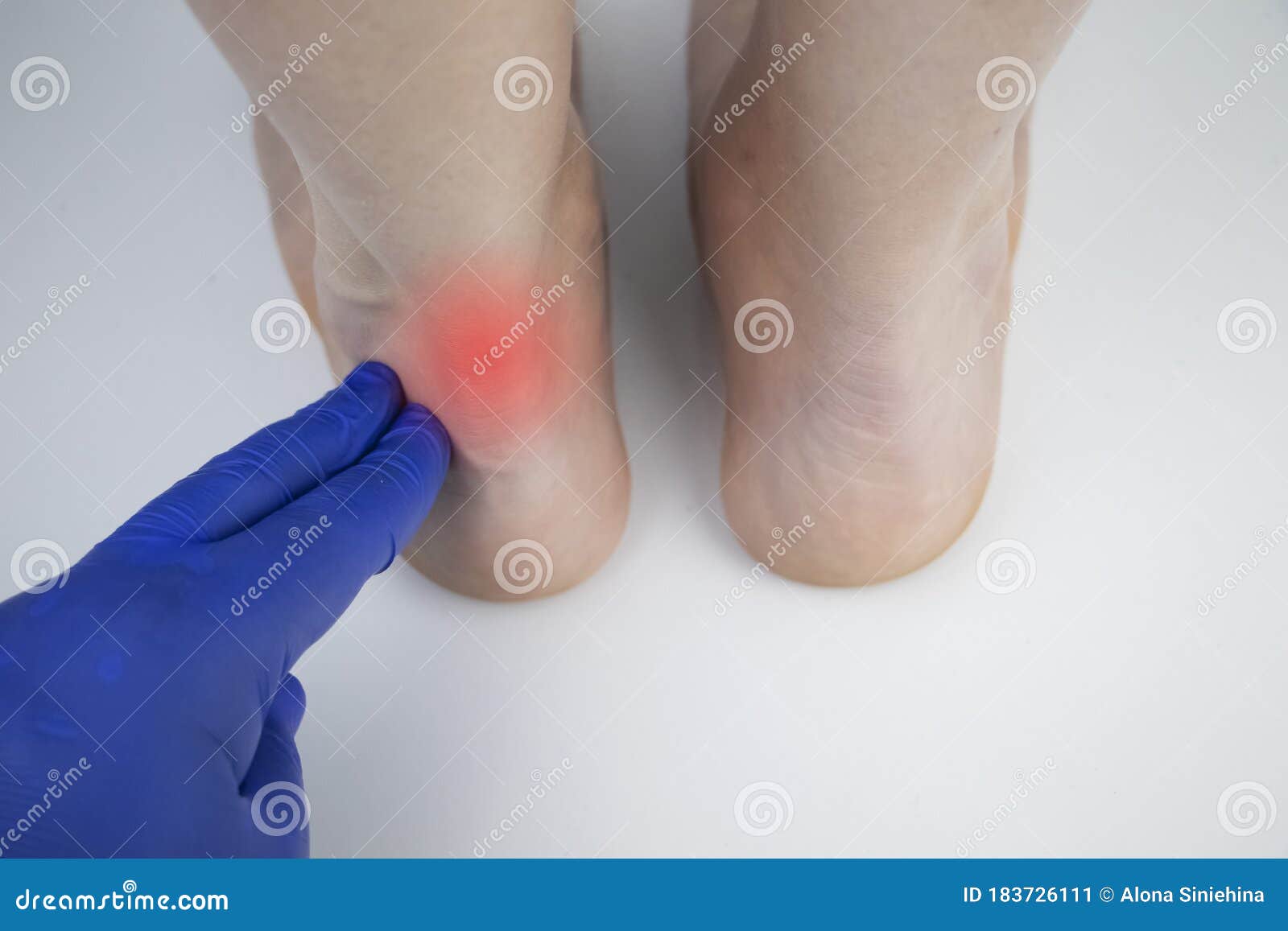 an orthopedic doctor examines a woman`s leg. achilles tendon and ankle diseases. inflammation of the heel and foot,