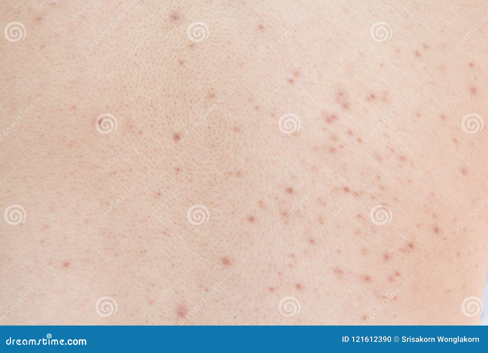 Acne on the back stock photo. Image of spots, dermatology 121612390