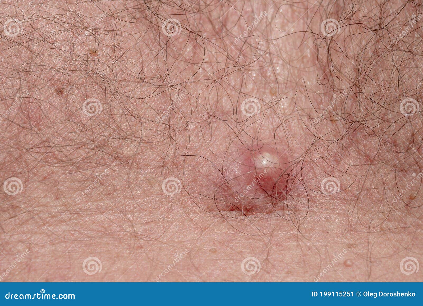 Acne On Body Skin Dermatological Disease Acne Closeup Stock Image