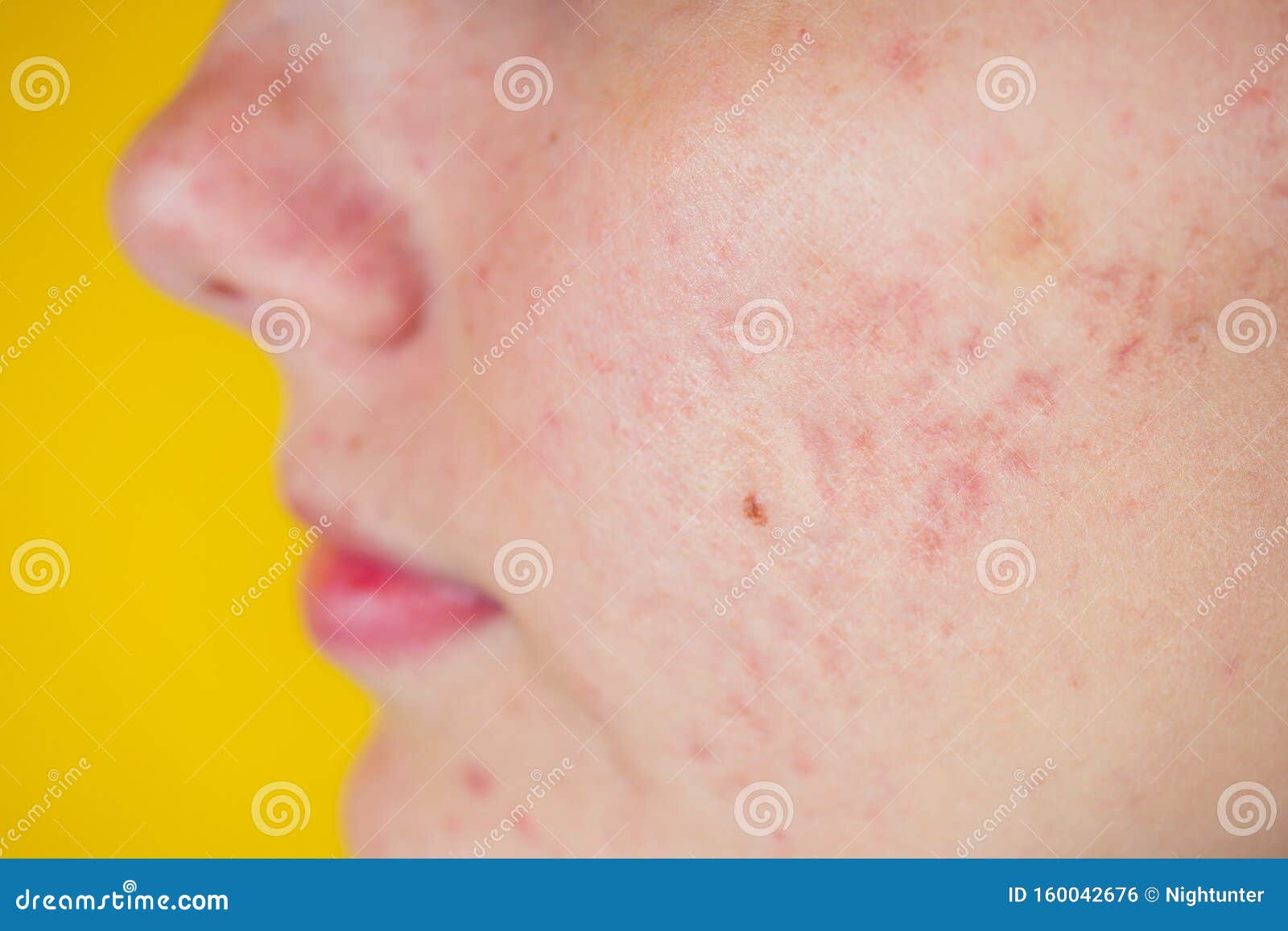 Acne Pus, Close Up Photo Of Acne Prone Skin, Woman Squeezing Her Pimple