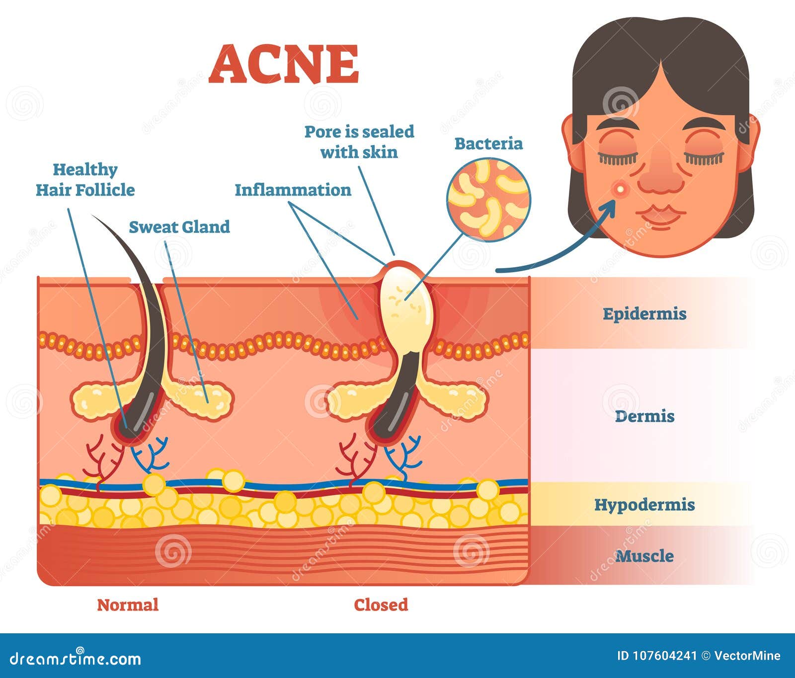 acne diagram  with hair, pimple, skin layers and structure. female face alongside. educational medical informat