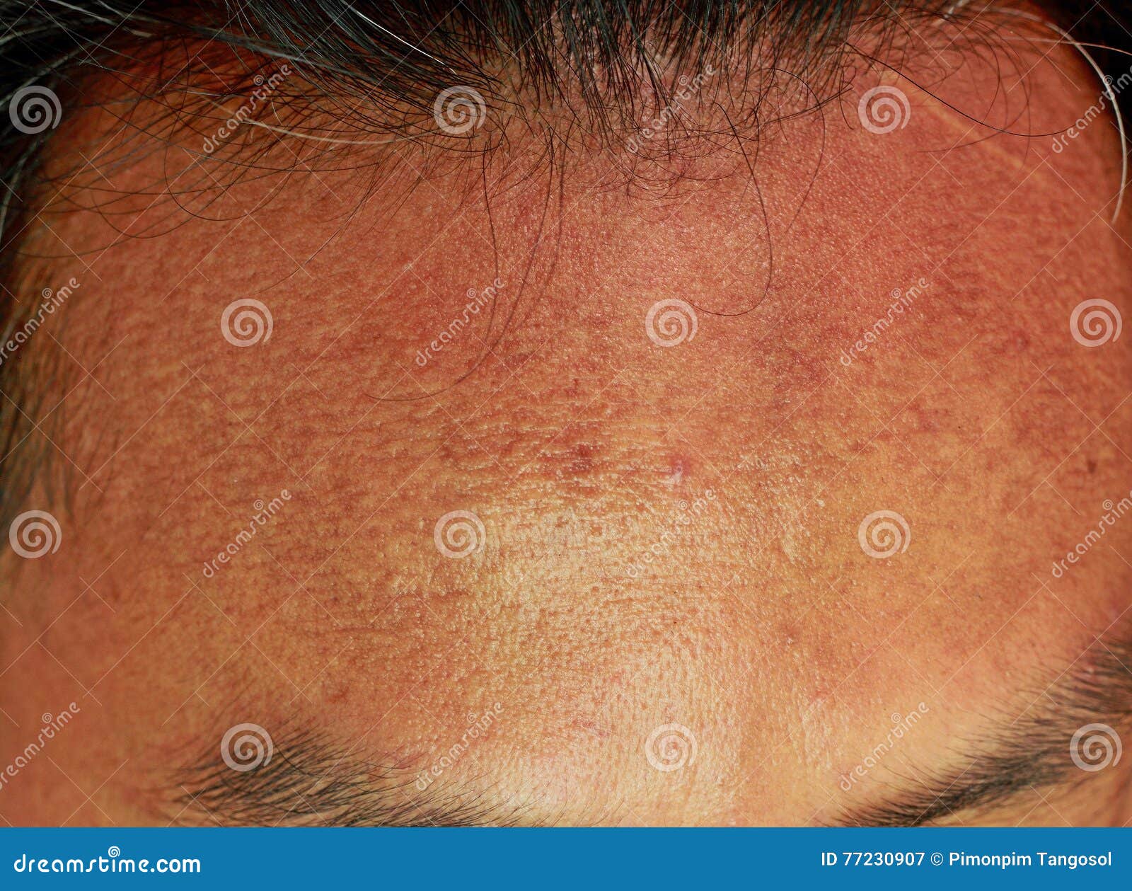 Acne Forehead Stock Image Image Of Inflammation Pizzaface 77230907