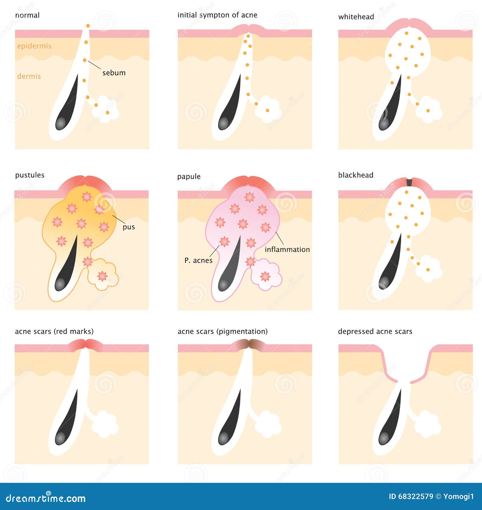 Guide to the Different Types of Acne - The Love Vitamin