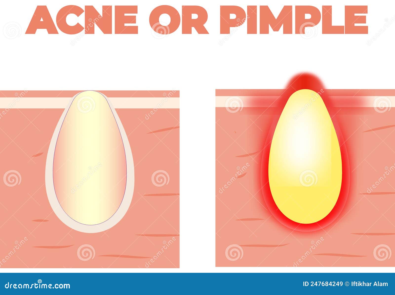 definitive lån flydende Acne Growing with a Lot of Pus and Giving a Red Hurting Alert Vector. Bron  or Pimple on the Skin with Yellow Pus Stock Vector - Illustration of  increasing, give: 247684249